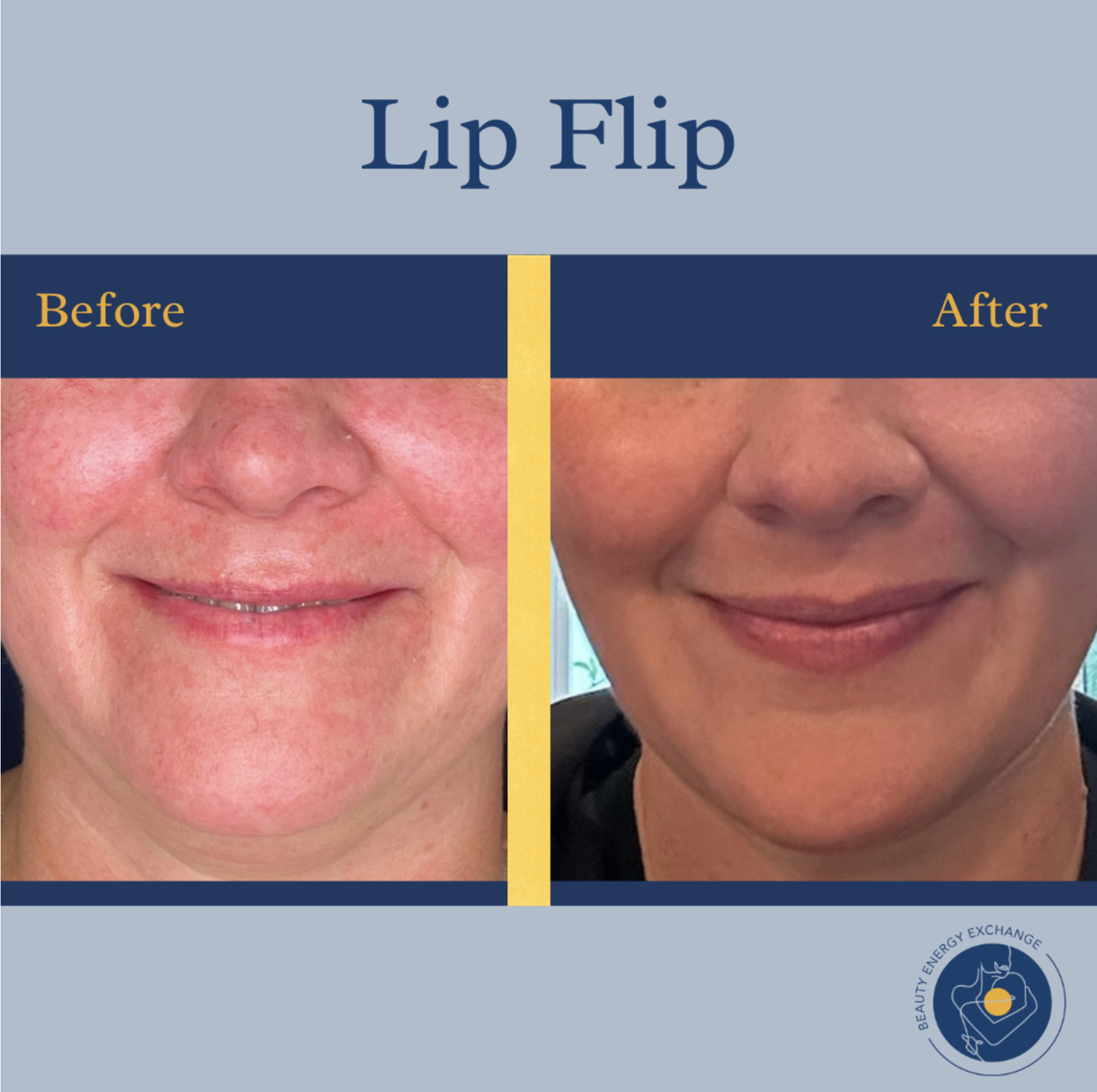 lip-flip-san-diego-before-after.png