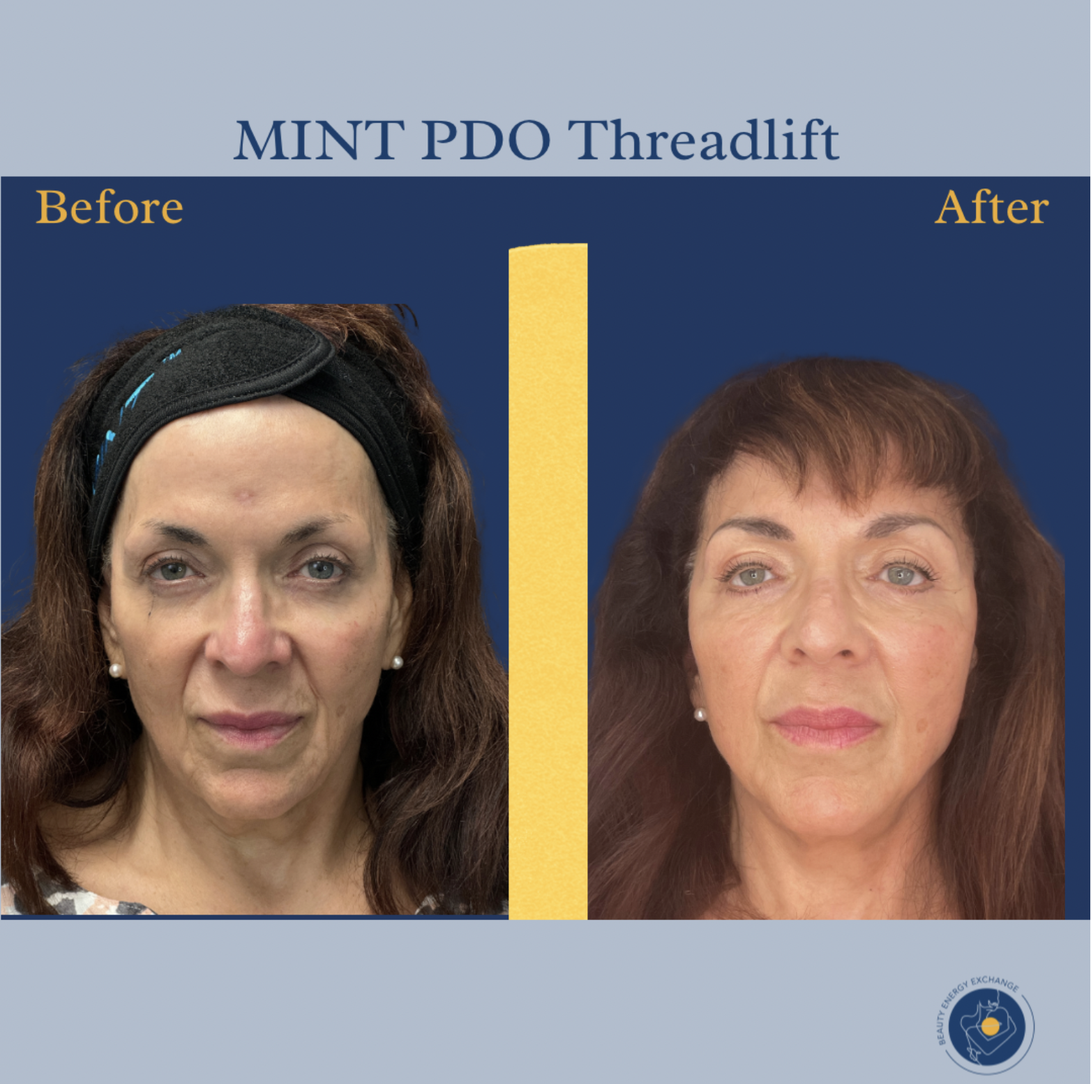 non-surgical facelift for Ocean Beach residents