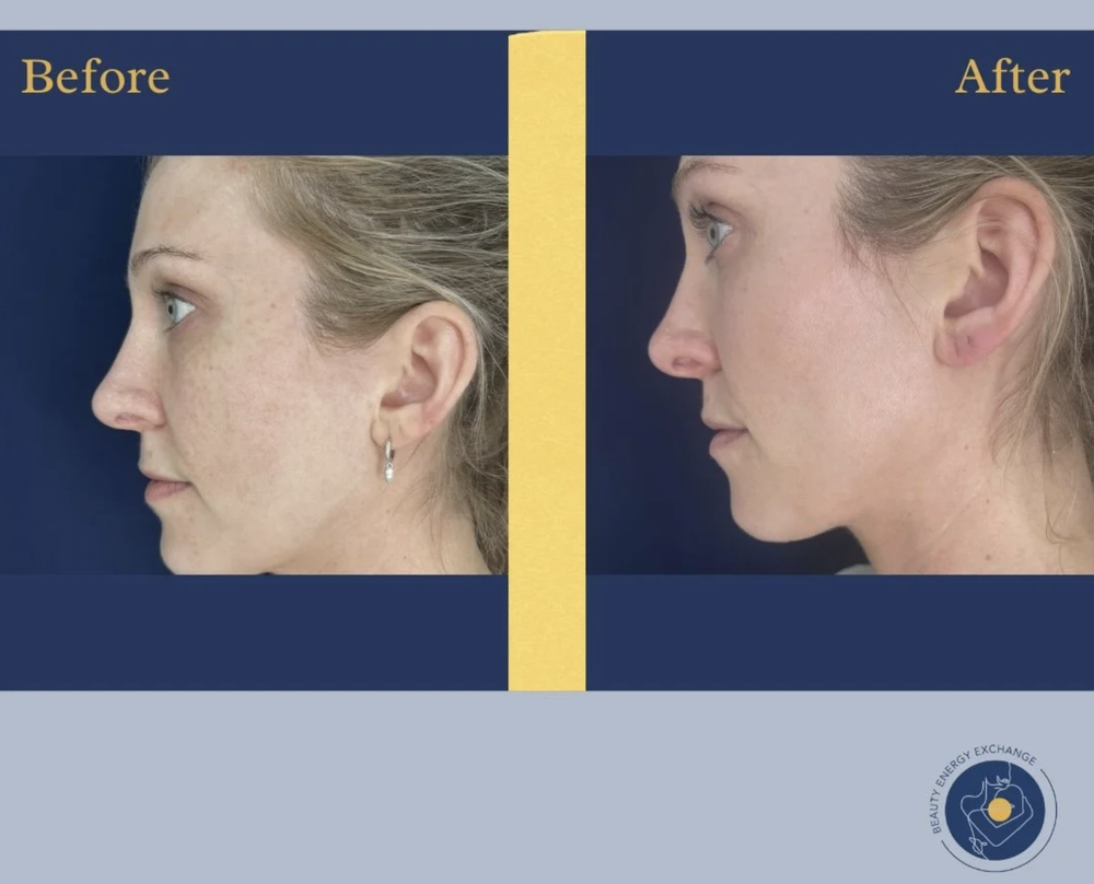 microneedline before after Ocean Beach