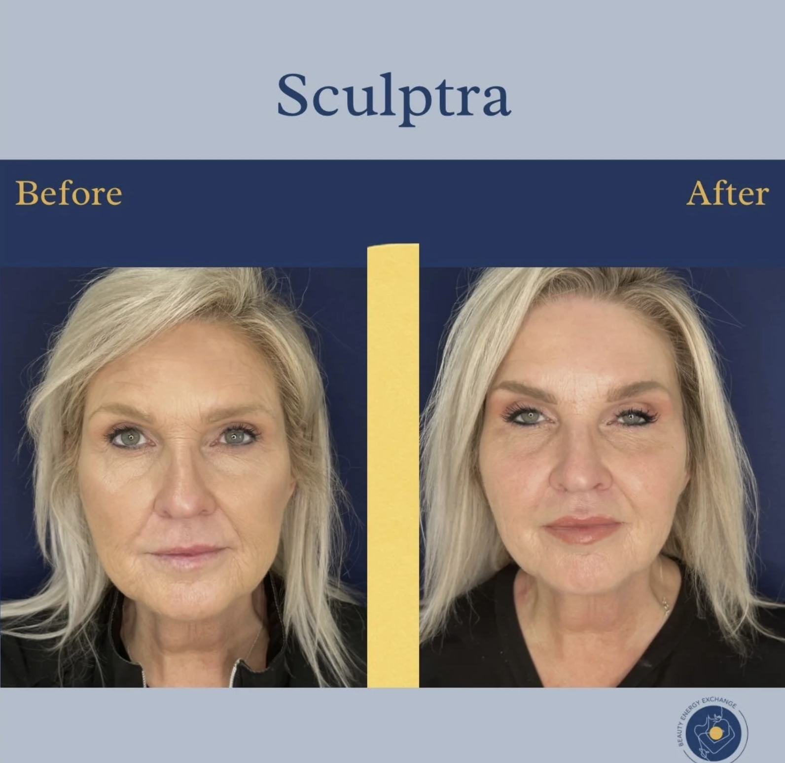 sculptra before after in Ocean Beach
