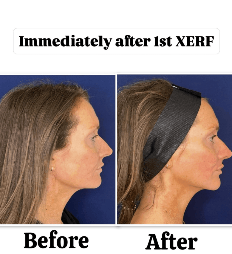 before after photo of XERF treatment side profile immediately after treatment