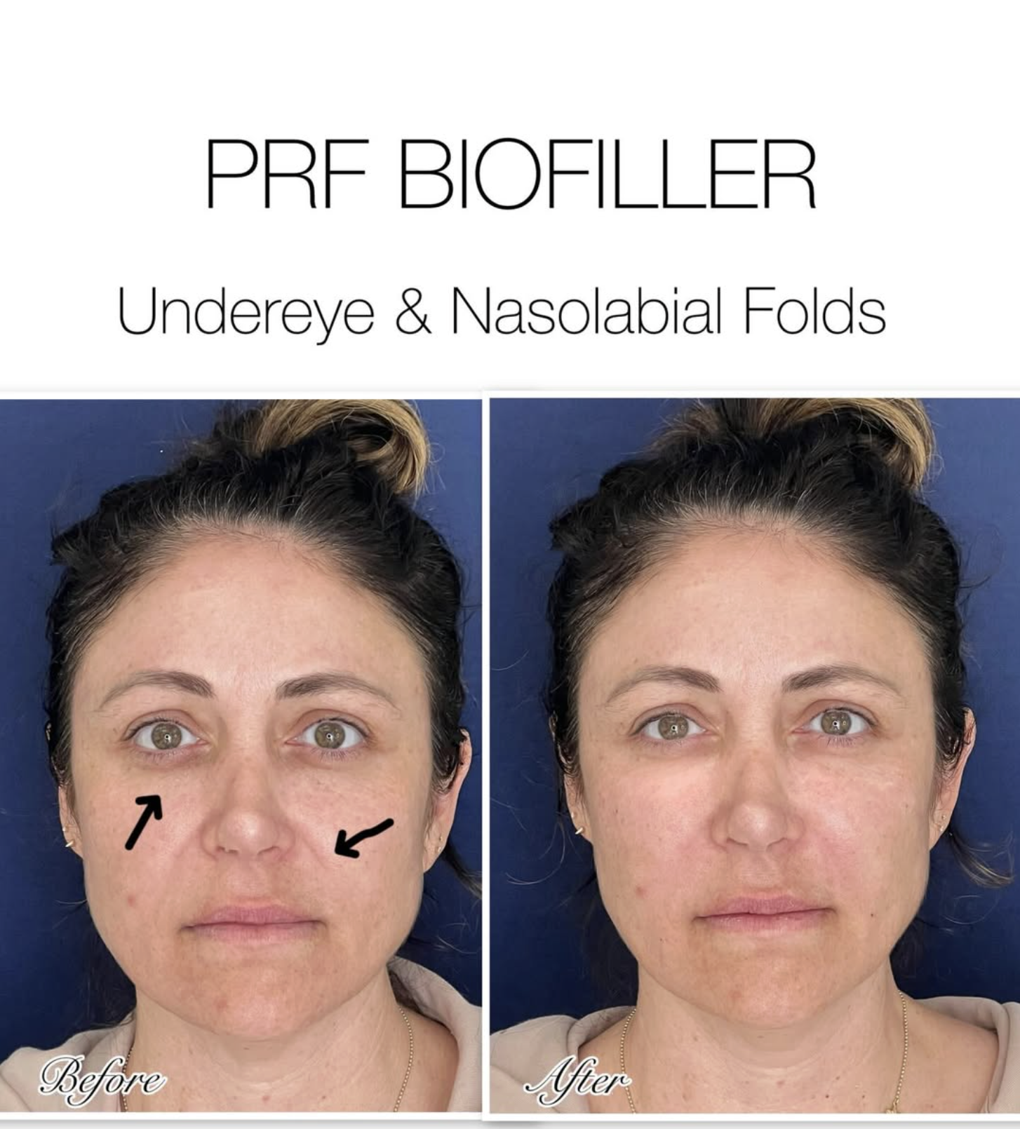 PRF biofiller before and after photo of undereye and nasolabial folds
