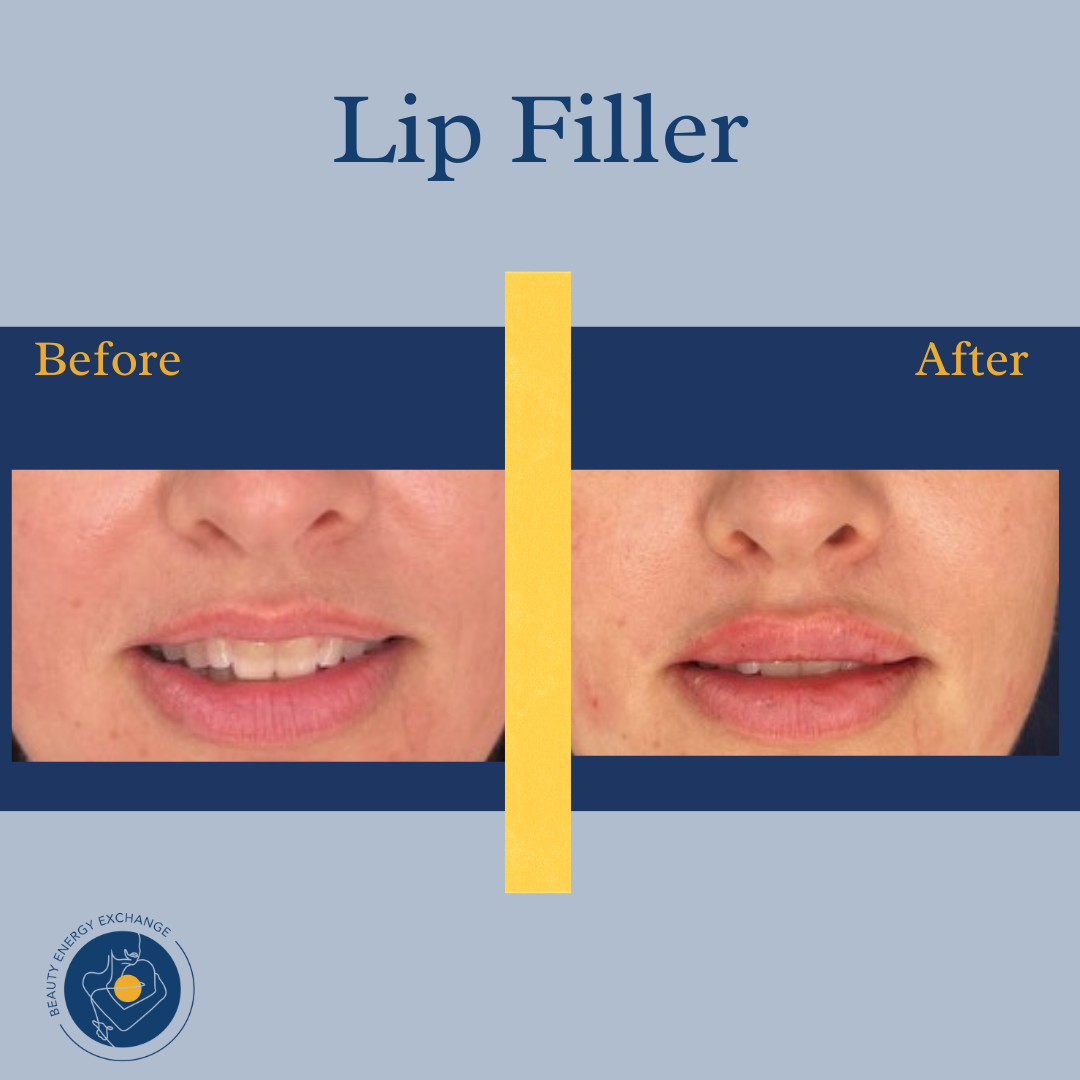 Lip Filler Result