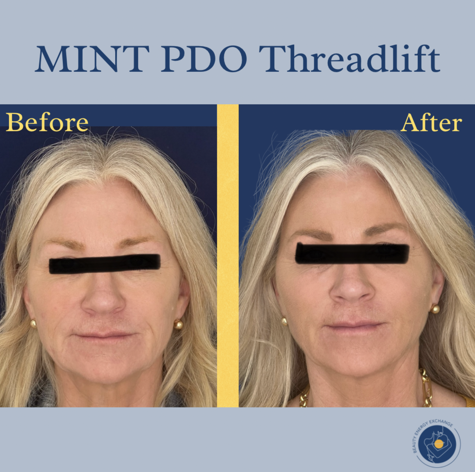 Nasolabial Fold Thread-Lift