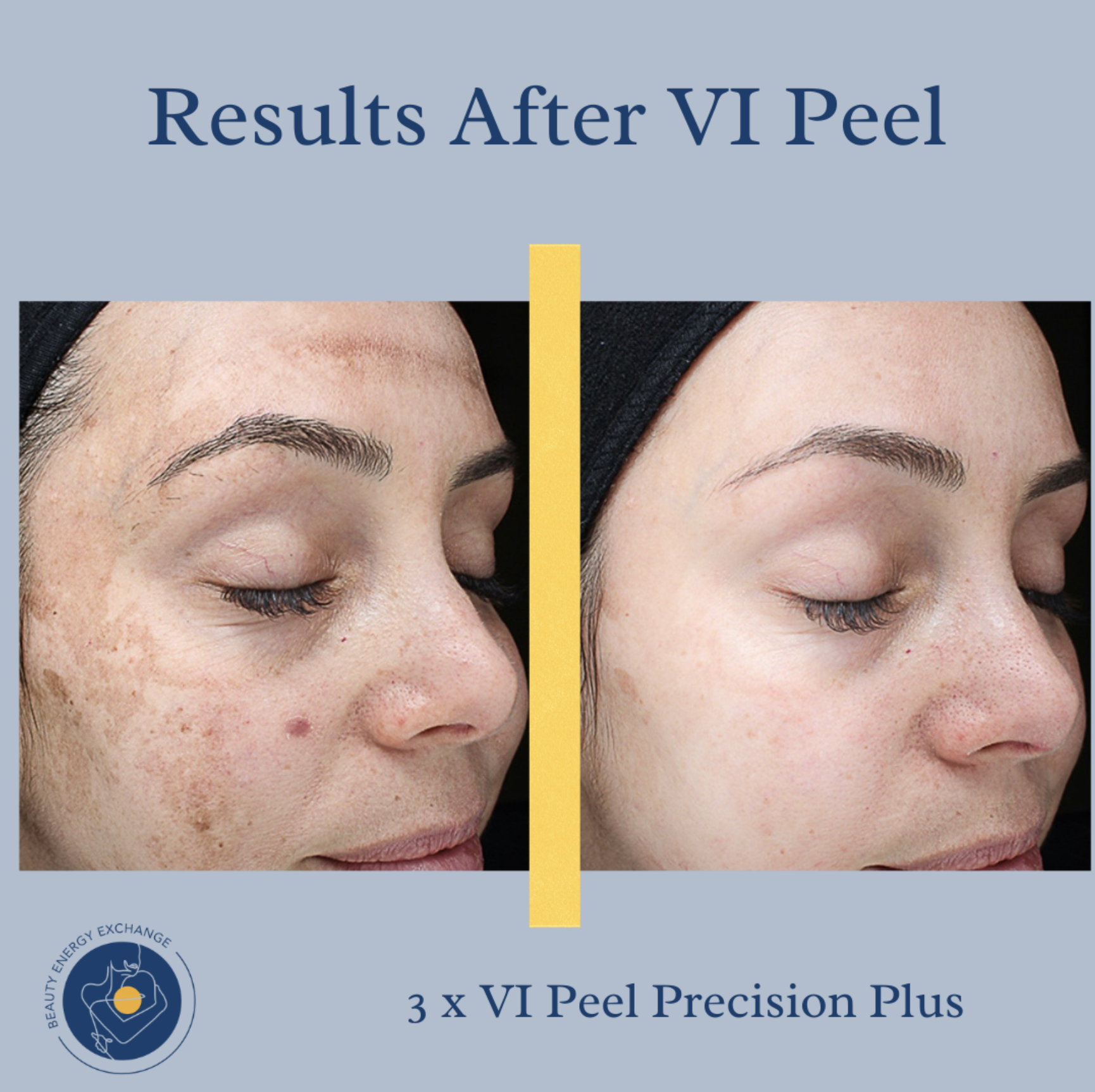 VI peel results before and after photo