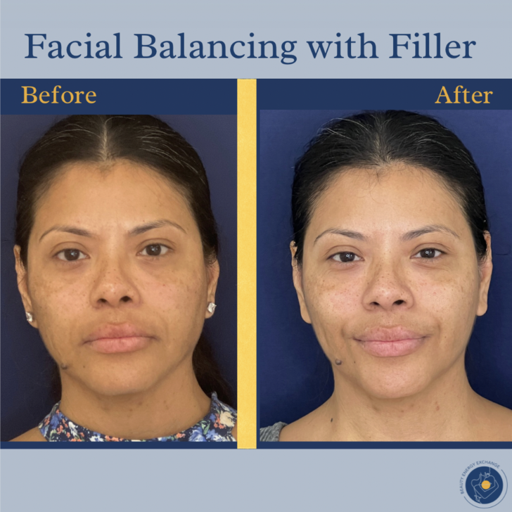 facial balancing with filler in San Diego
