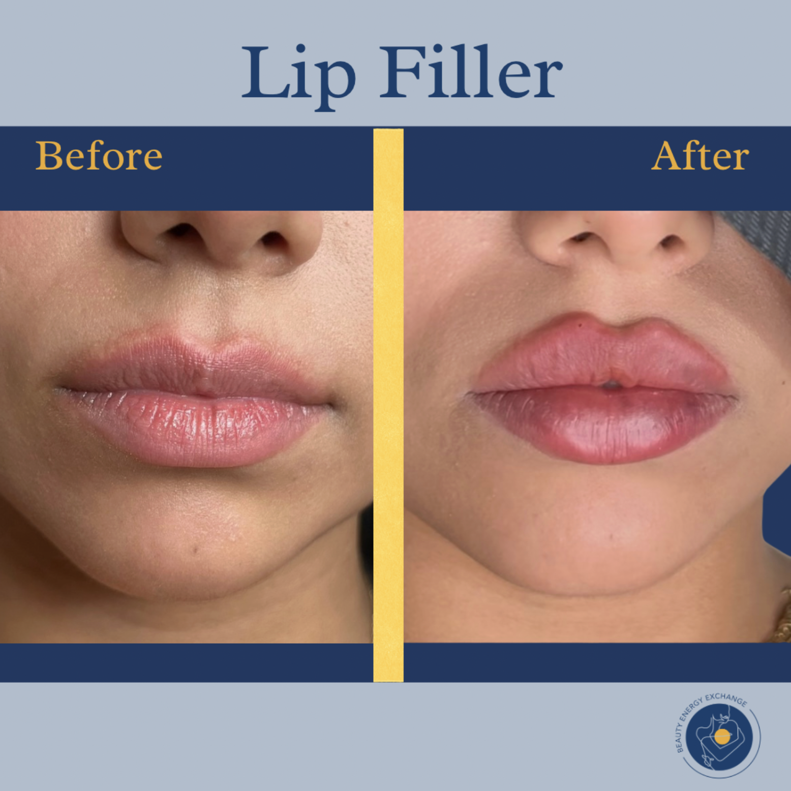 russian lip filler Ocean Beach