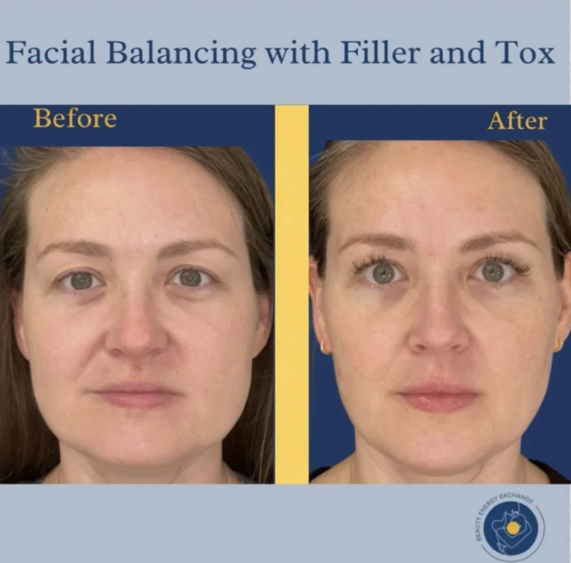 Botox and Wrinkle Relaxers