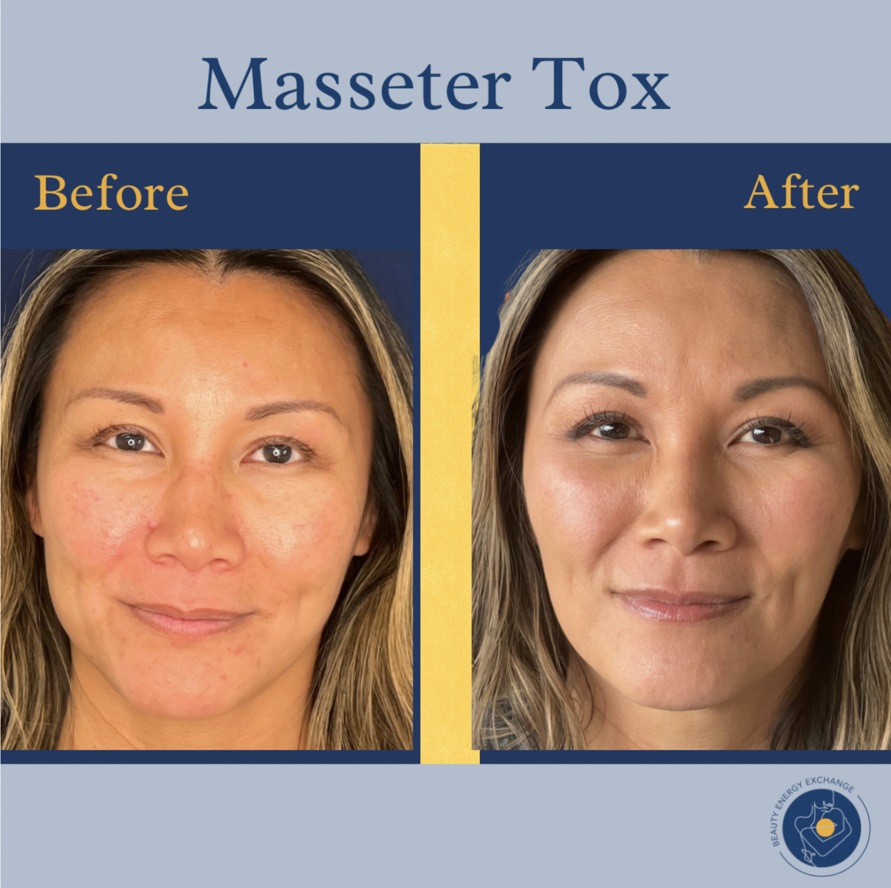 masseter-botox-before-after-san-diego.png