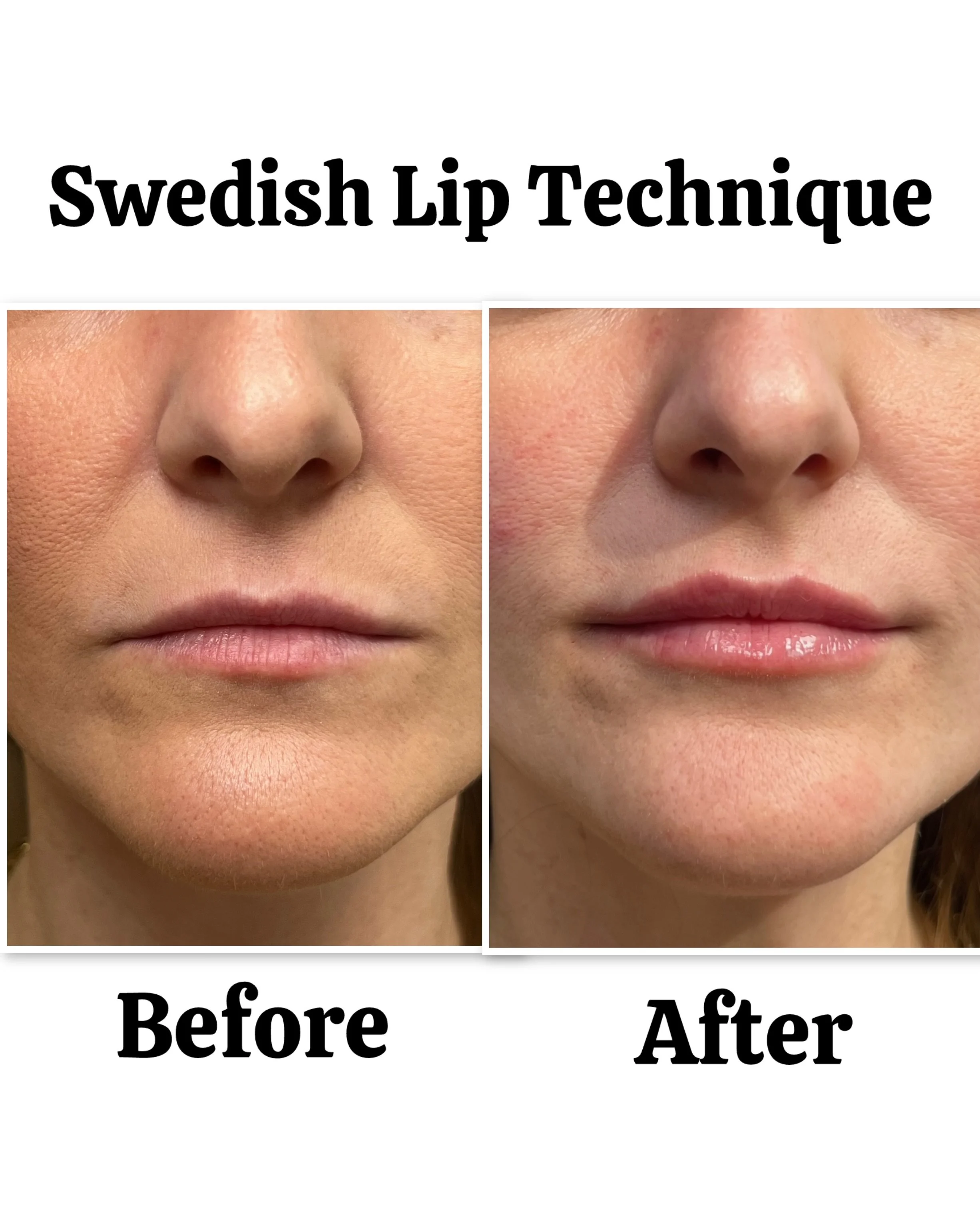 subtle-lip-fillers-point-loma-07.jpeg