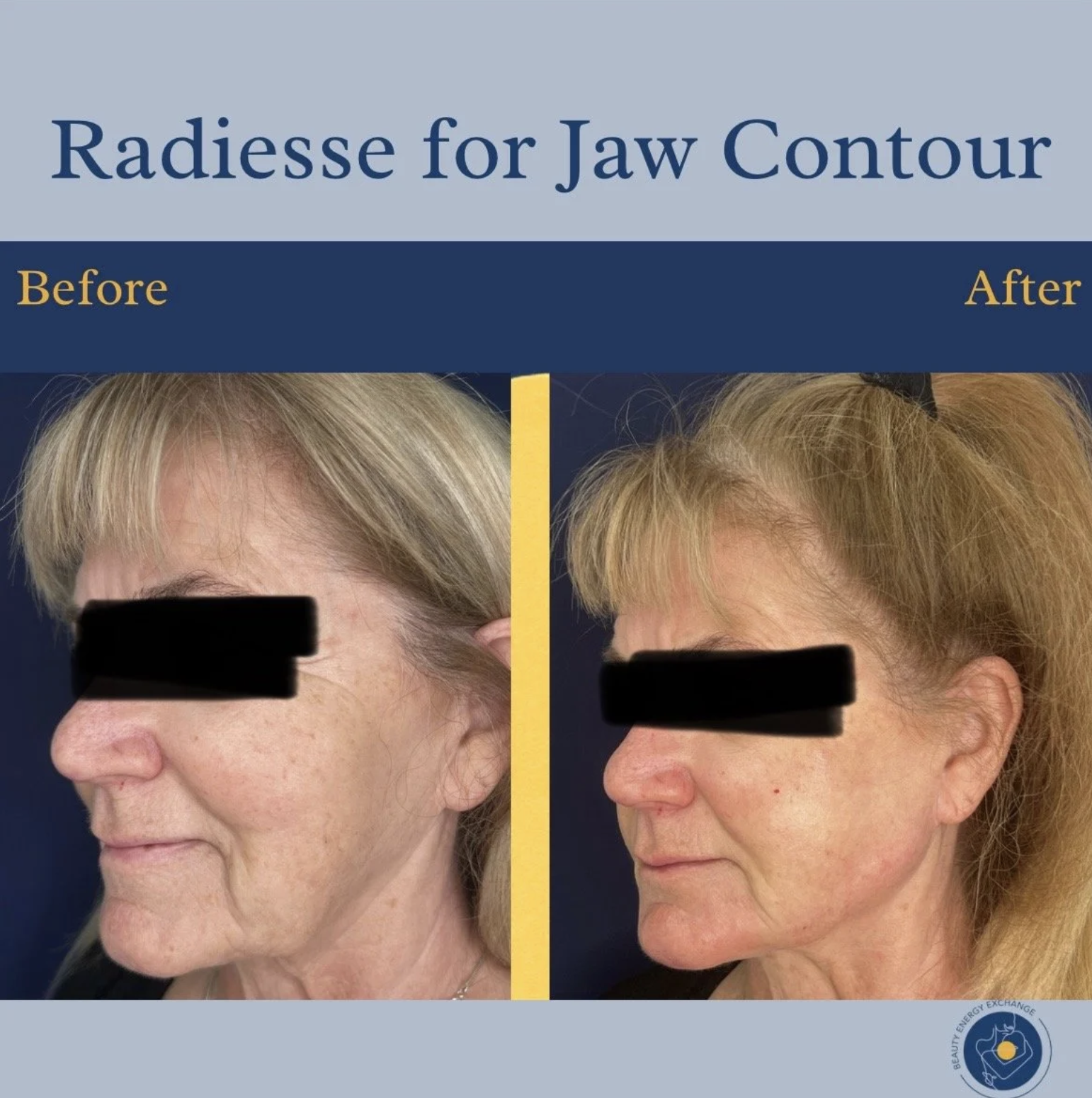 Radiesse Jaw Contour