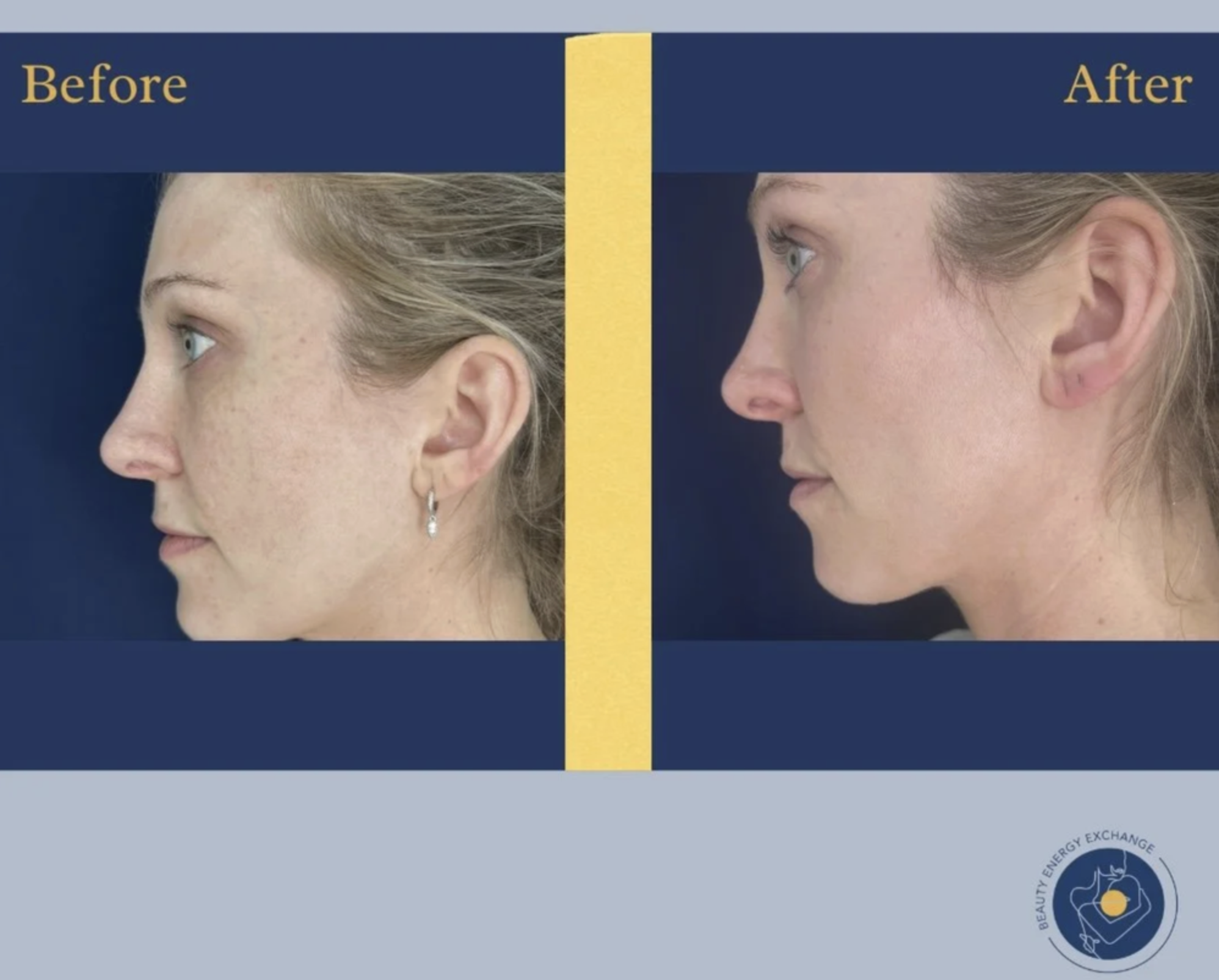 microneedling before after photo