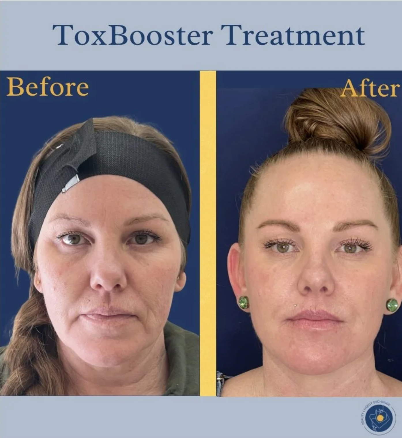 botox-before-after--san-diego.png