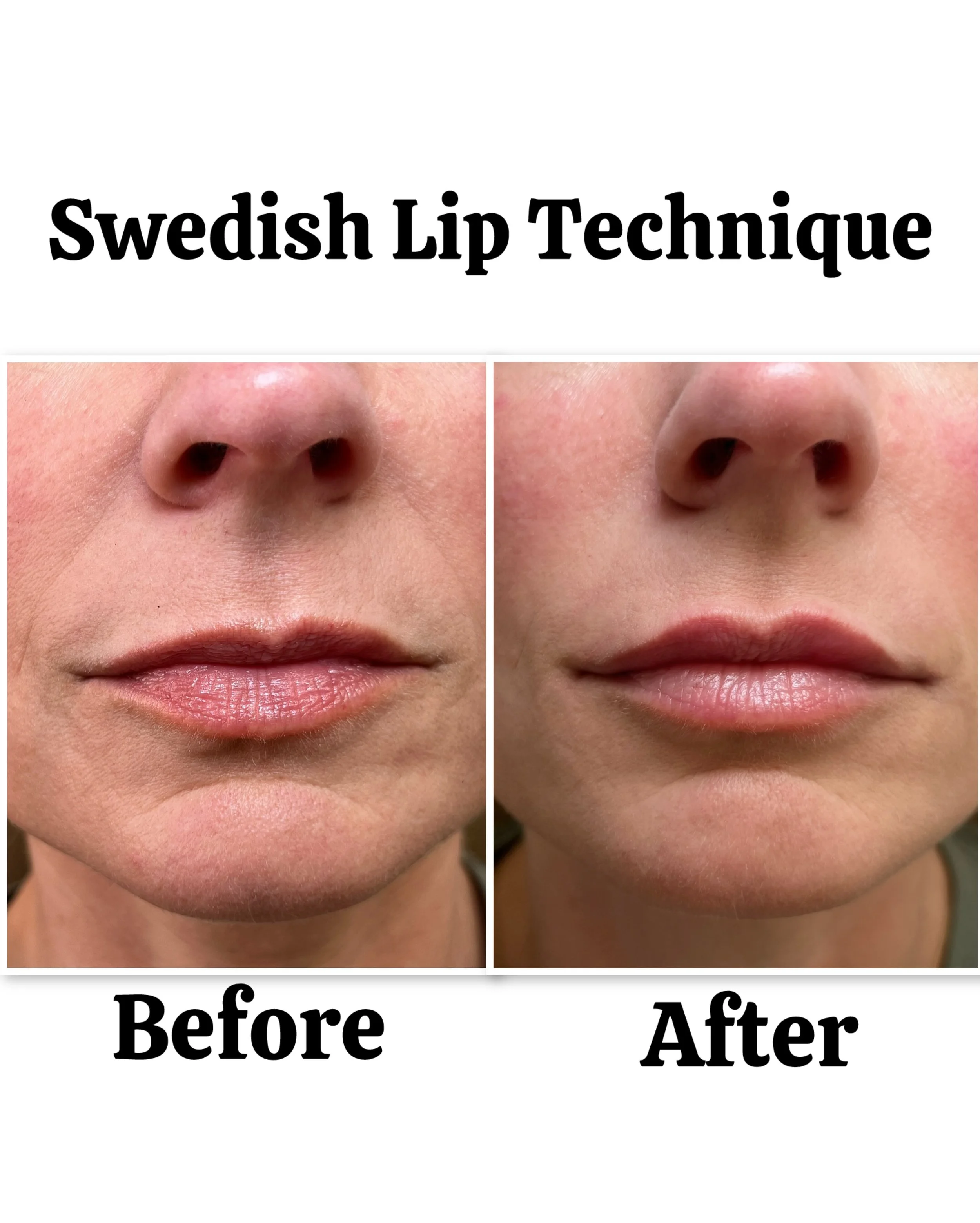 aesthetic-lip-fillers-point-loma-11..jpeg