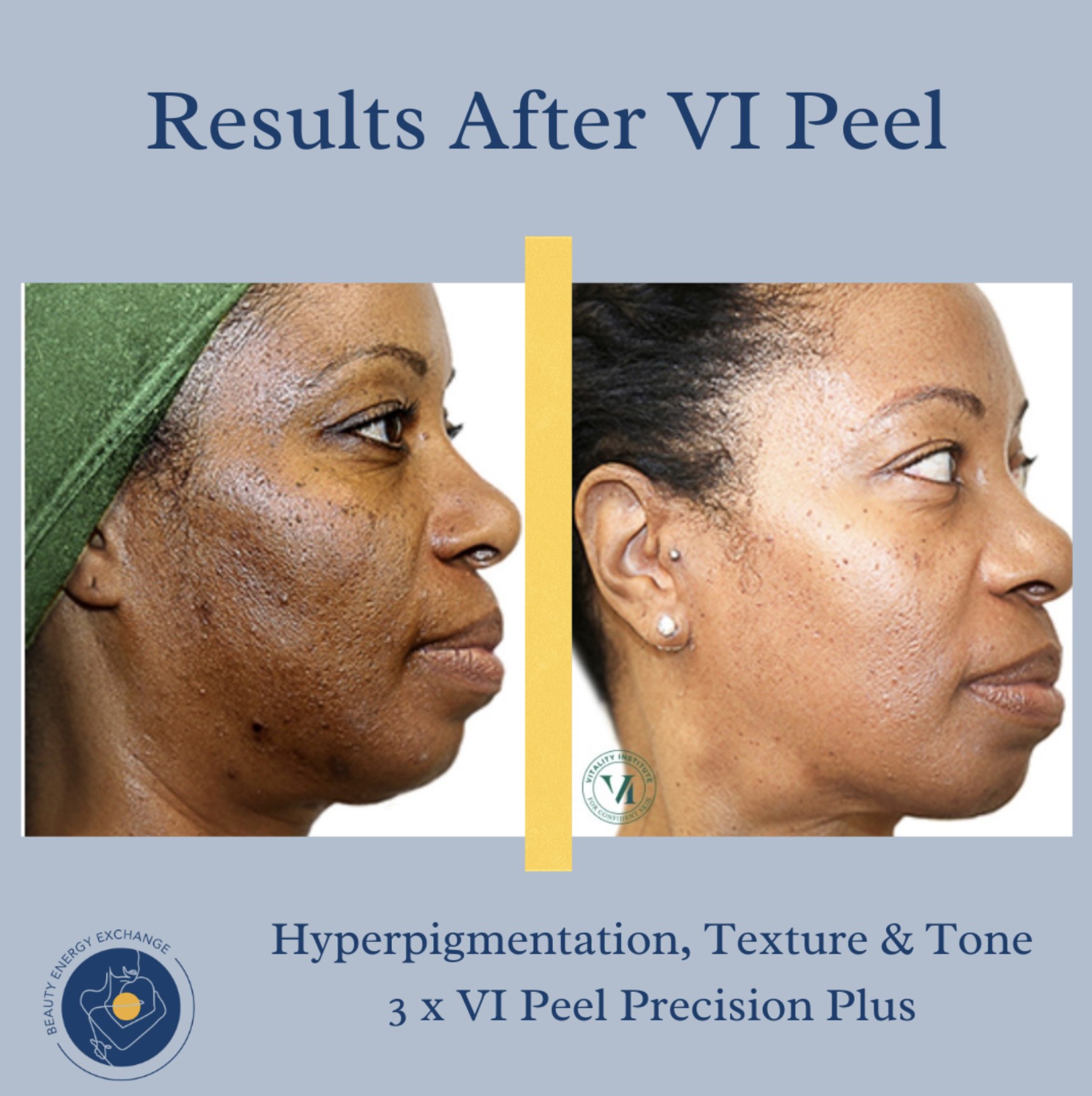 results from VI peel before and after