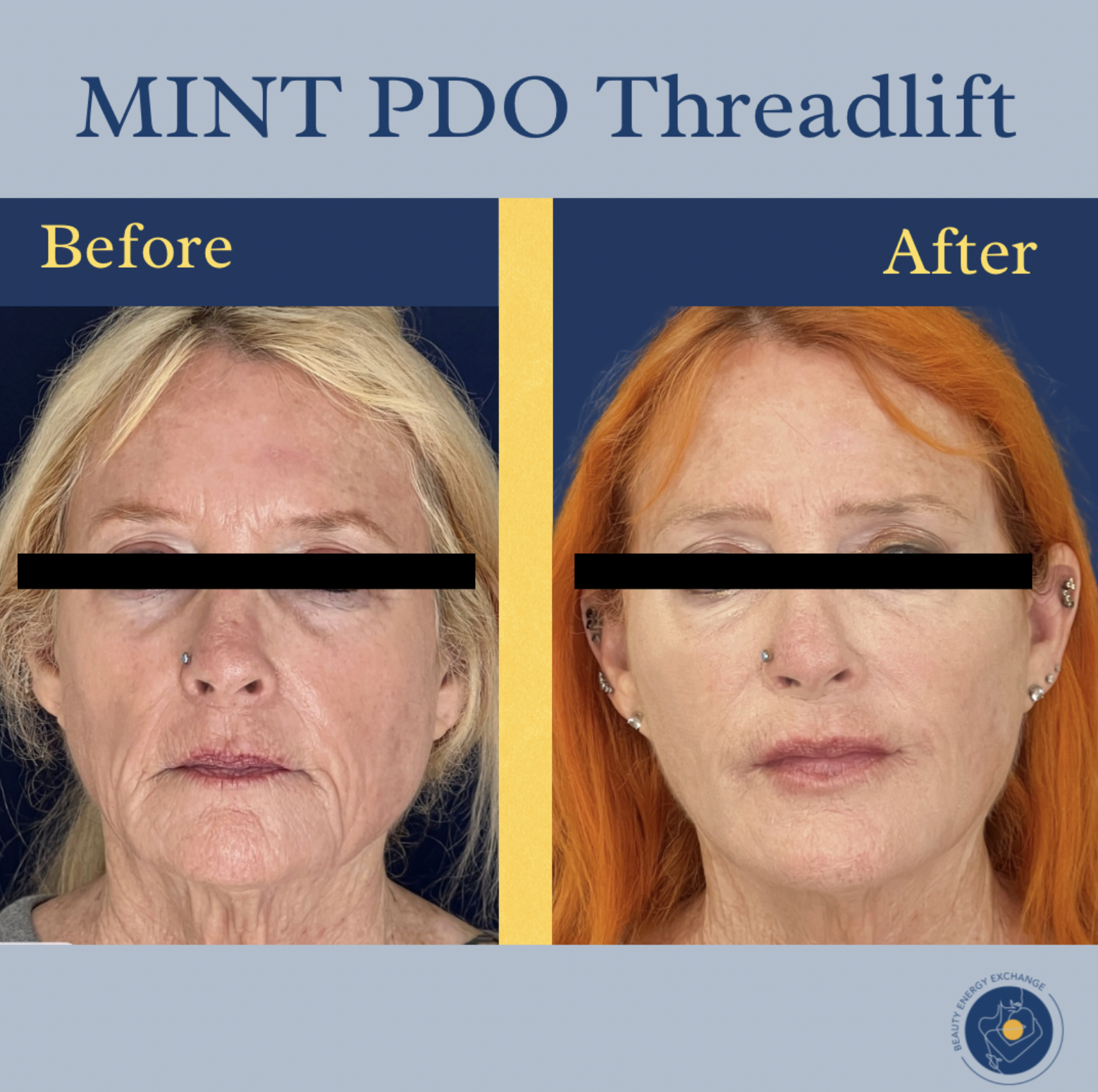 PDO thread lift results in Ocean Beach