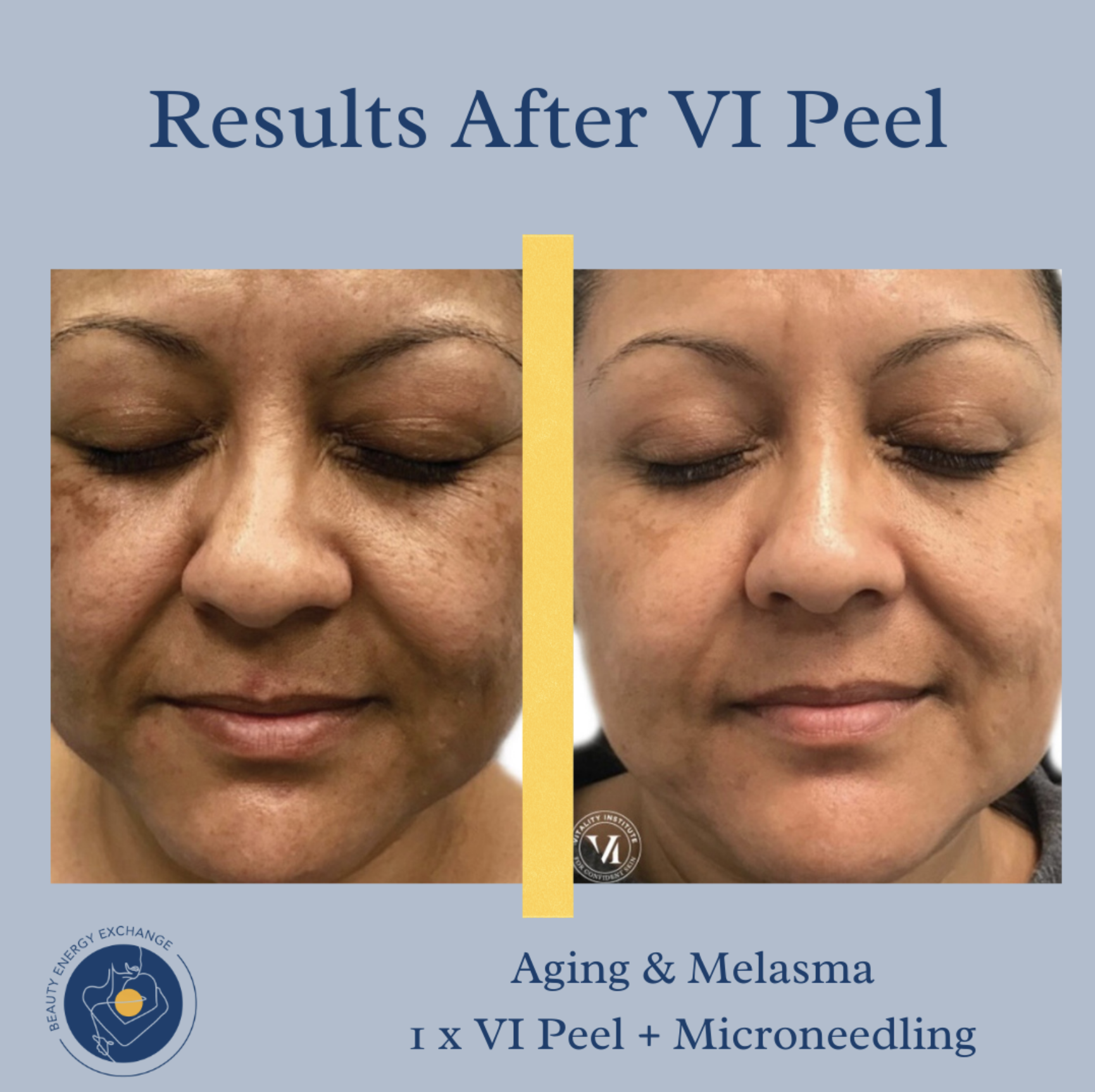chemical peel results, brightened complexion, less fine lines