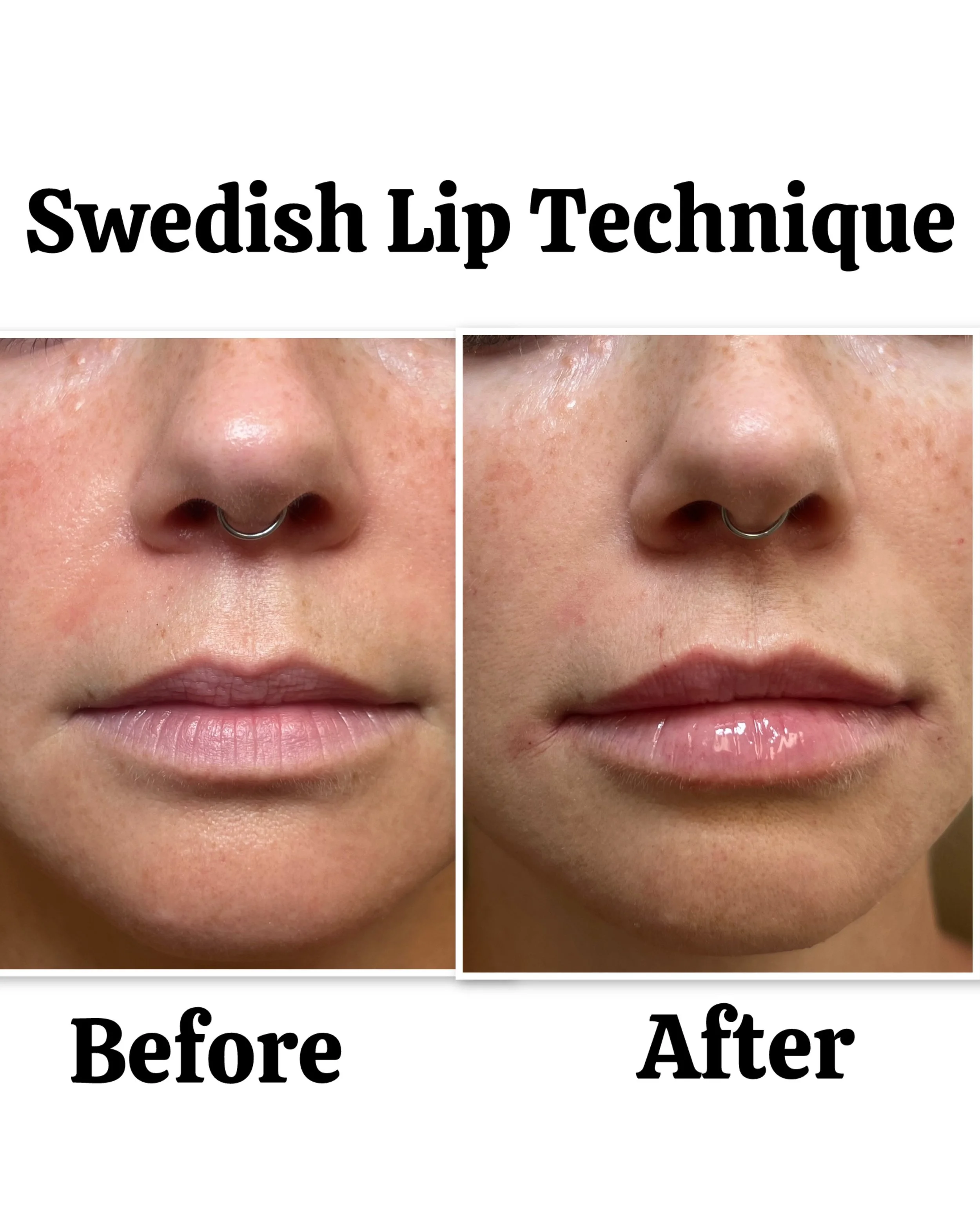 expert-lip-injections-point-loma-09.jpeg