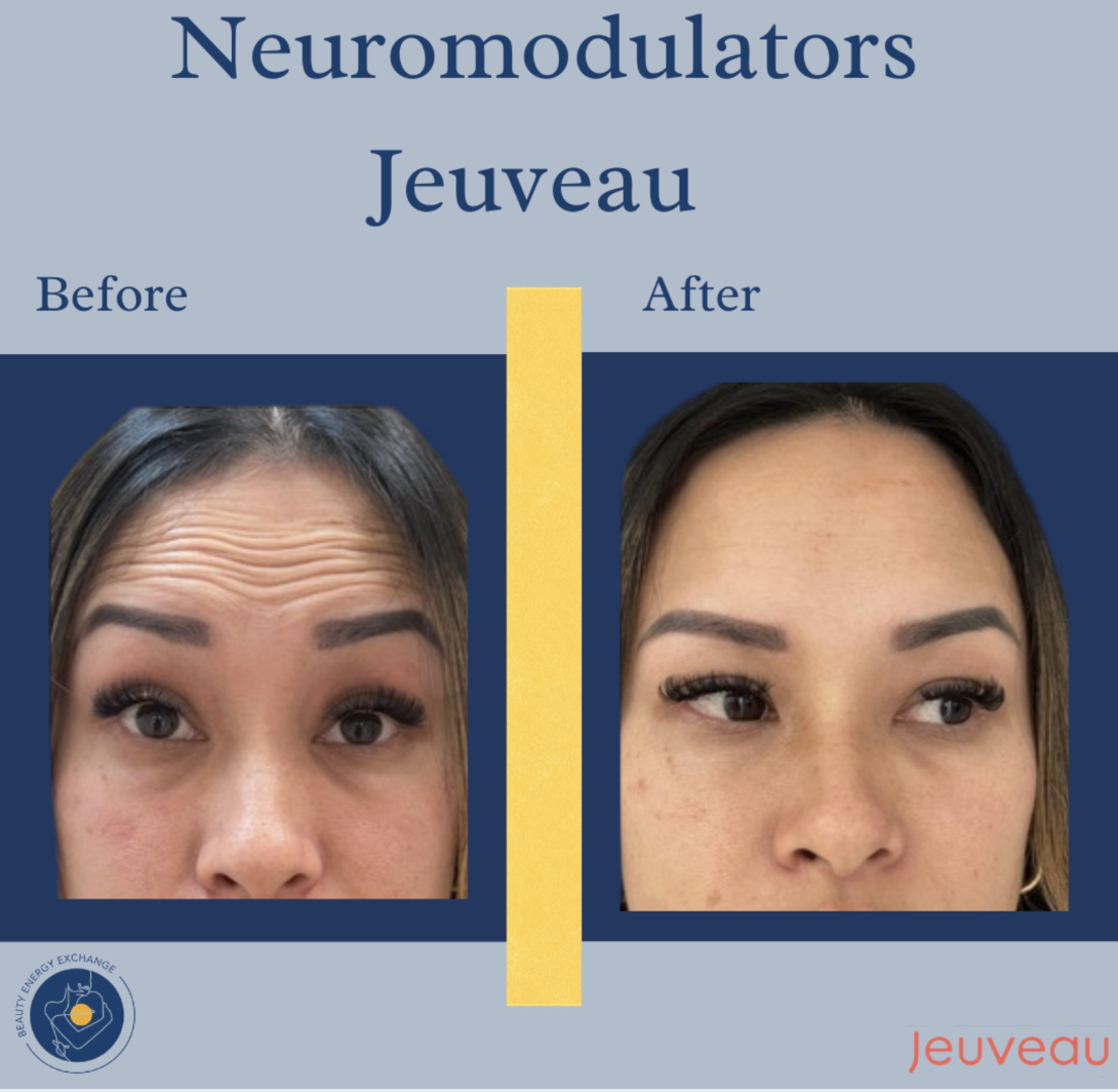 natural looking botox in San Diego