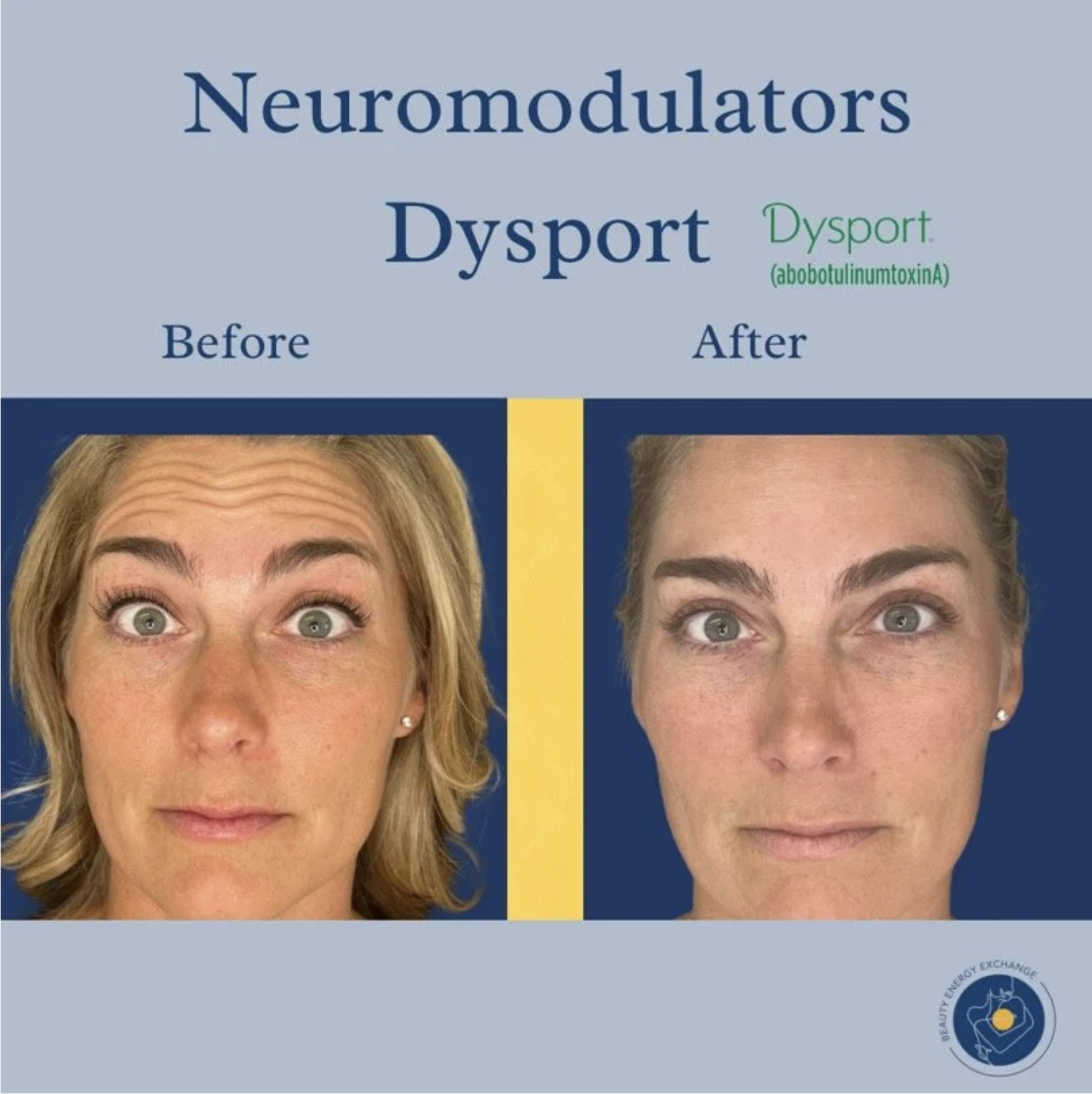 dysport-before-after-san-diego.png