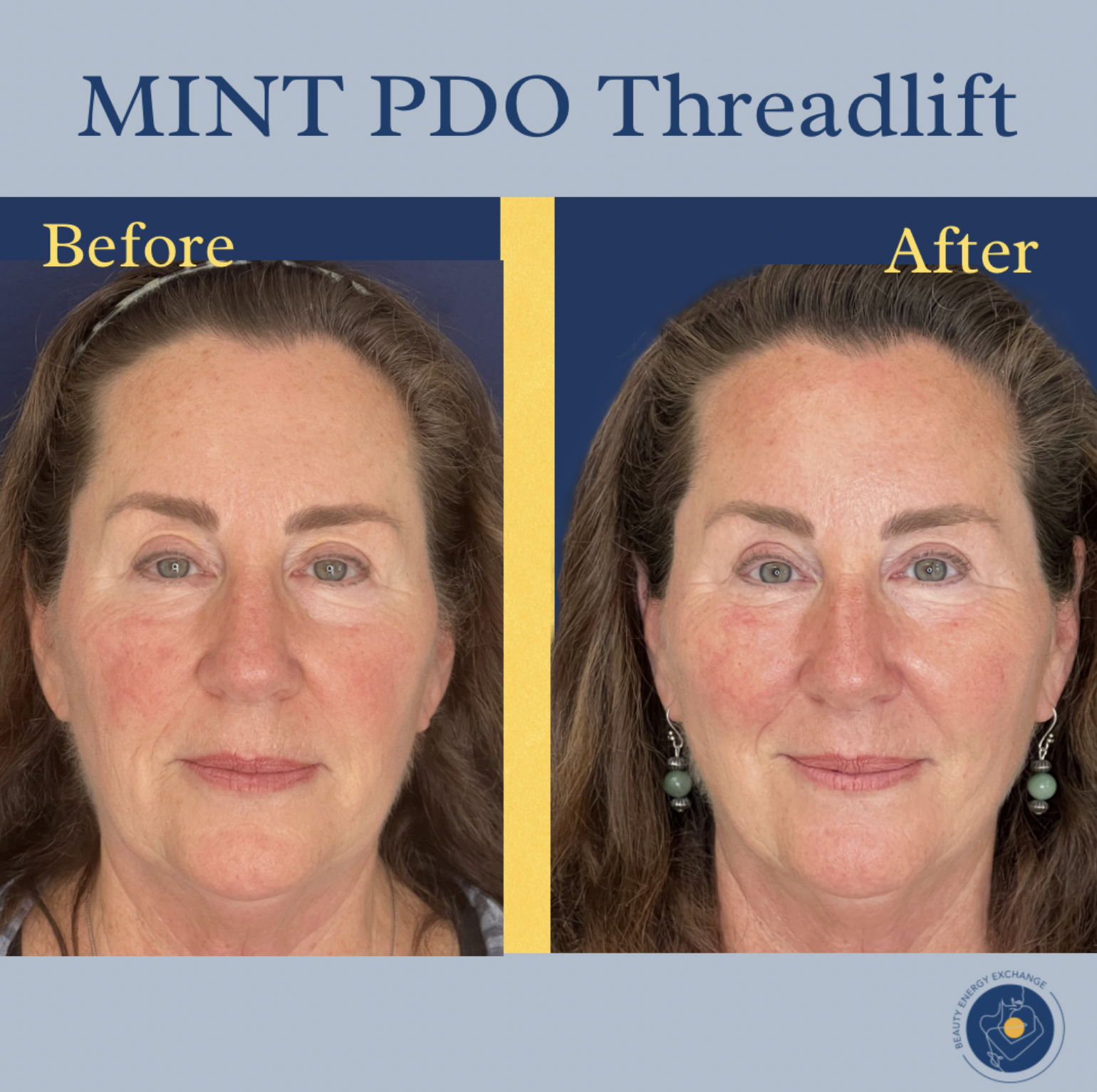 pdo threadlift San Diego
