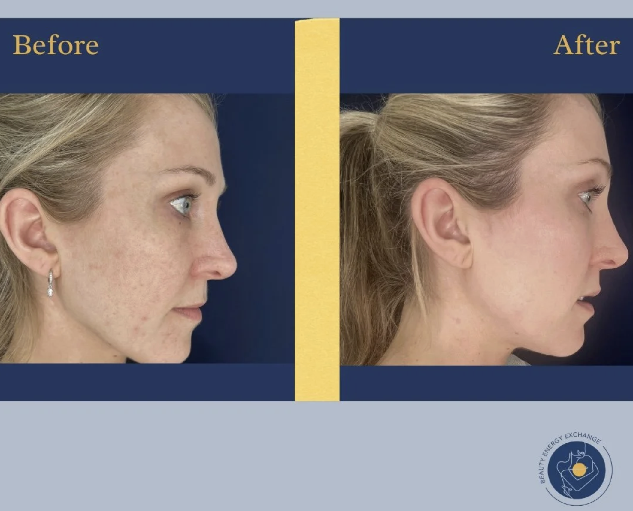 microneedling Ocean Beach