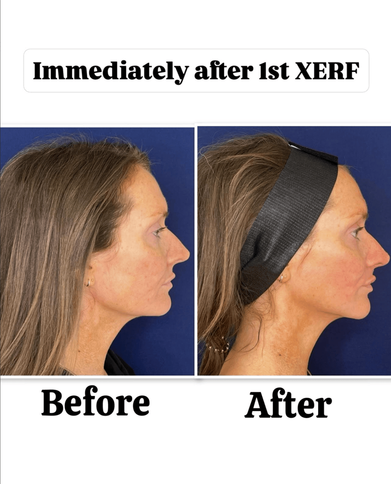 XERF results before after