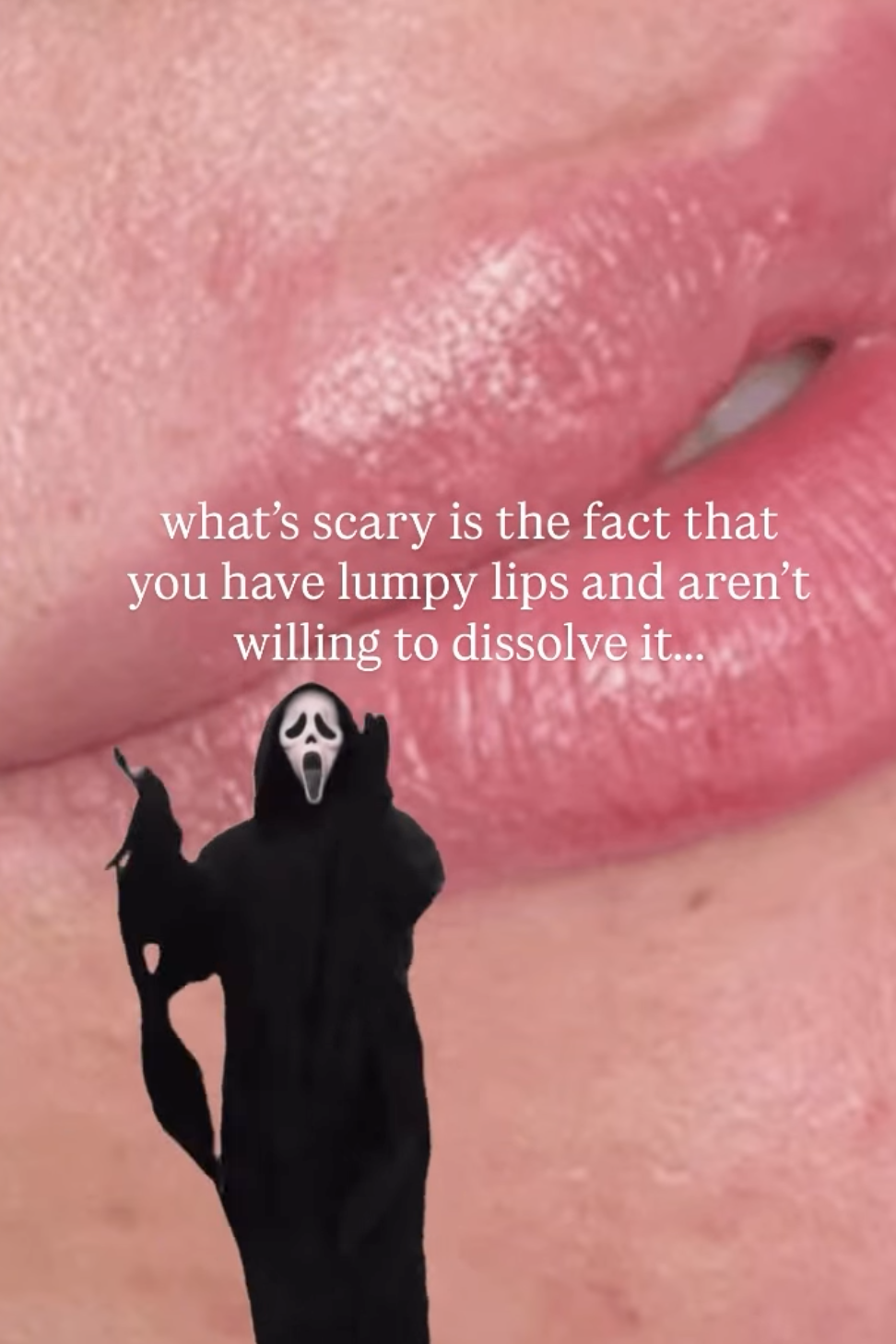 what over-filled lips look like