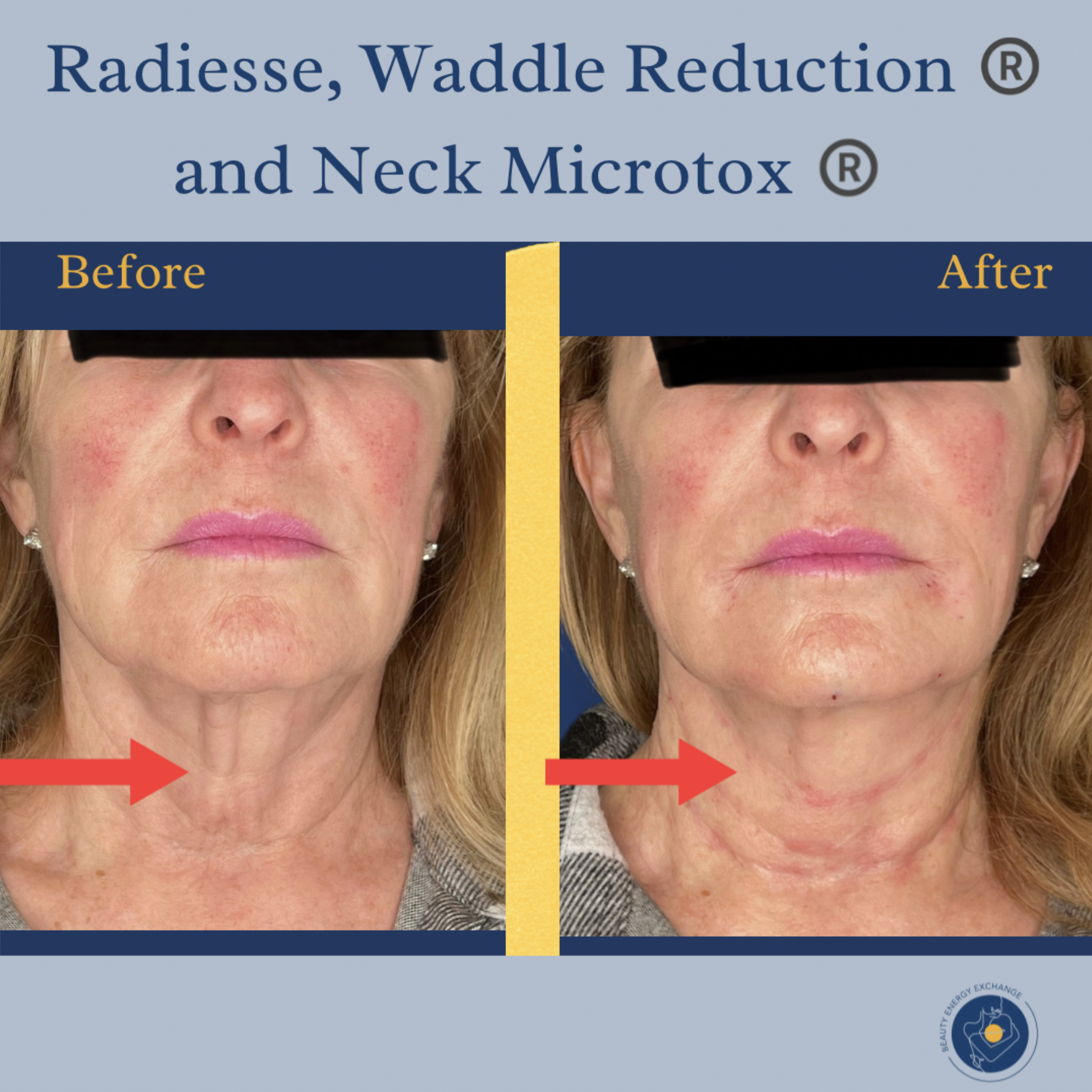 neck-botox-san-diego-before-after.png