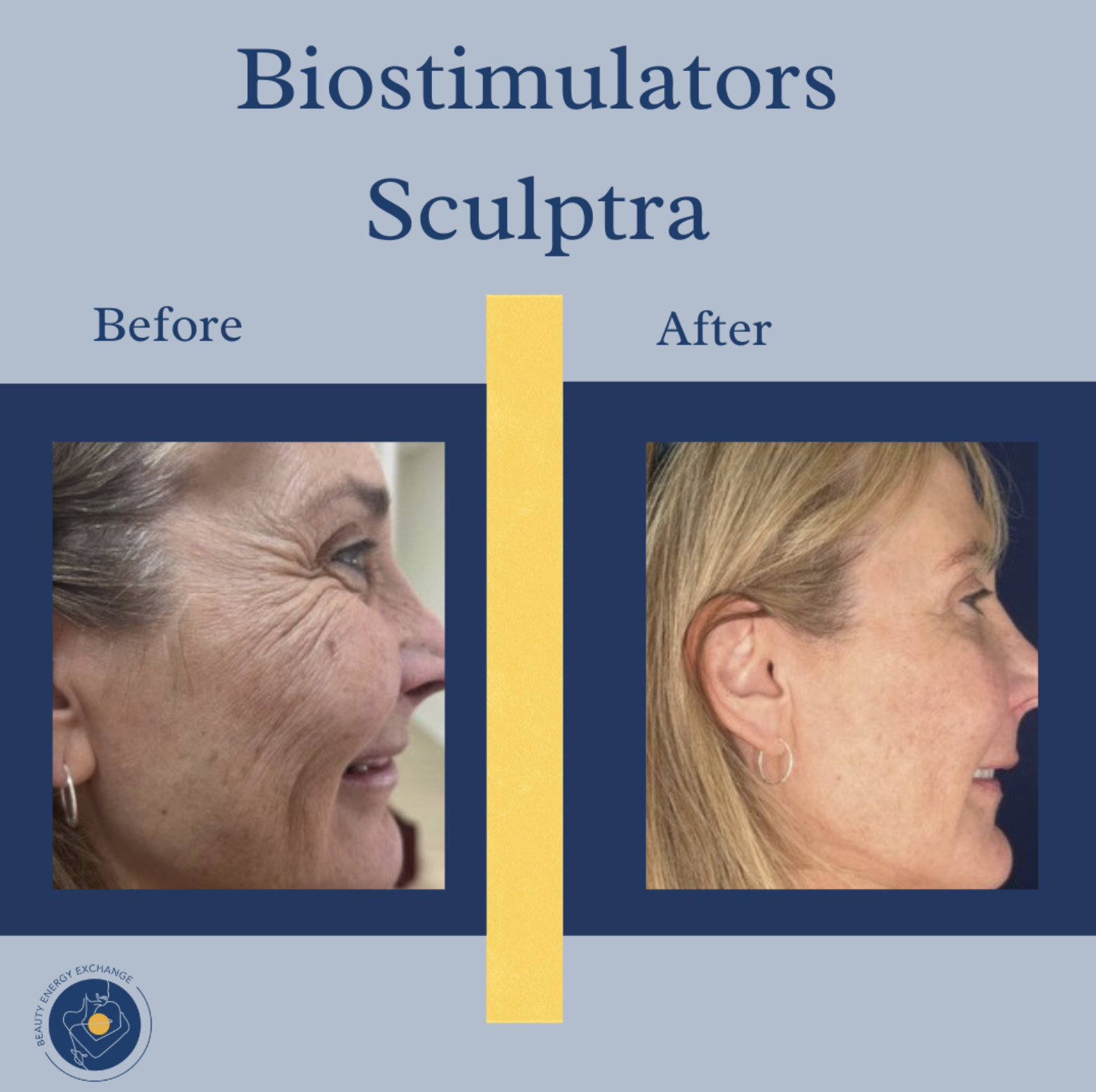 What to Expect From Sculptra or Radiesse Treatments