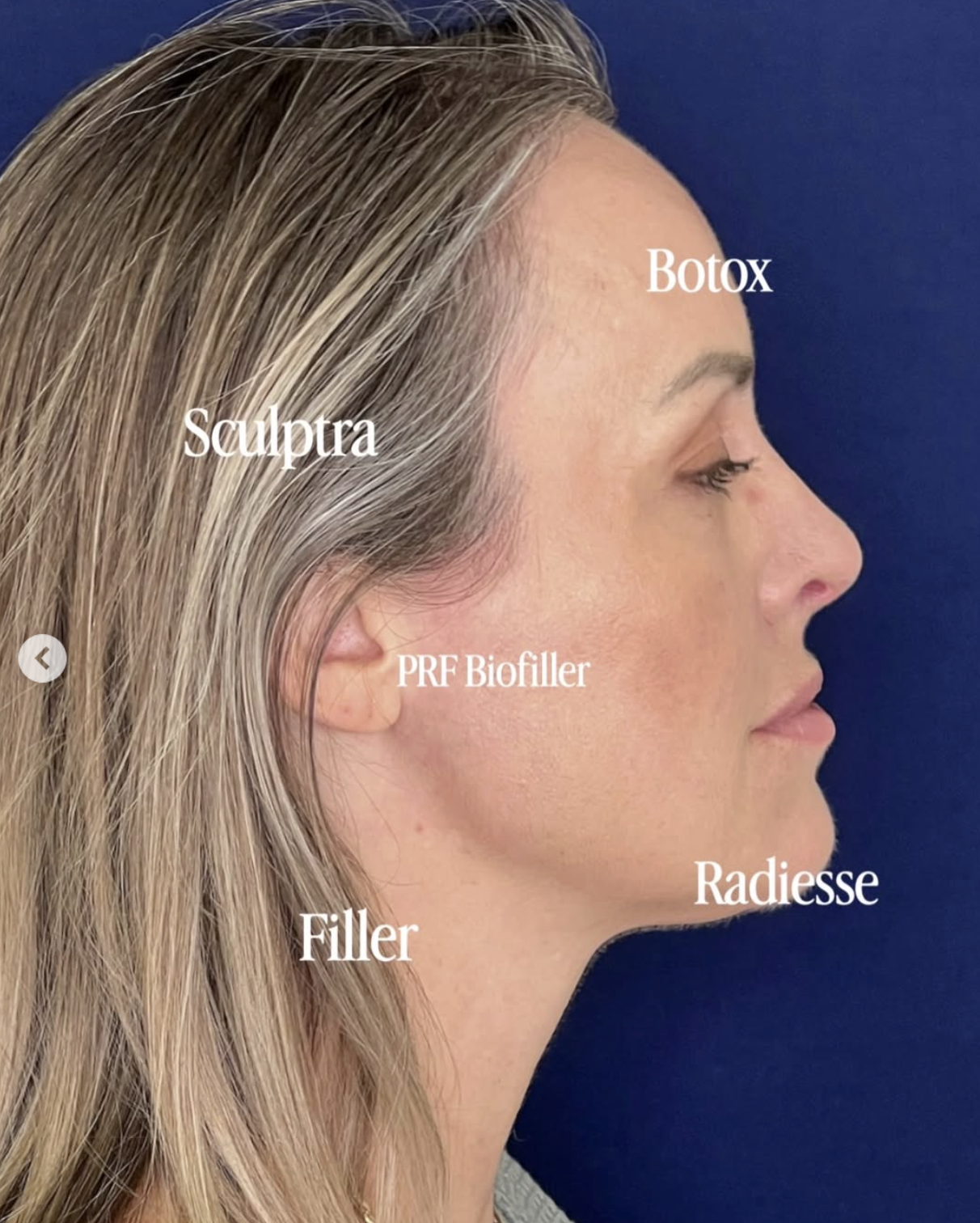 combination treatments for jowls without surgery