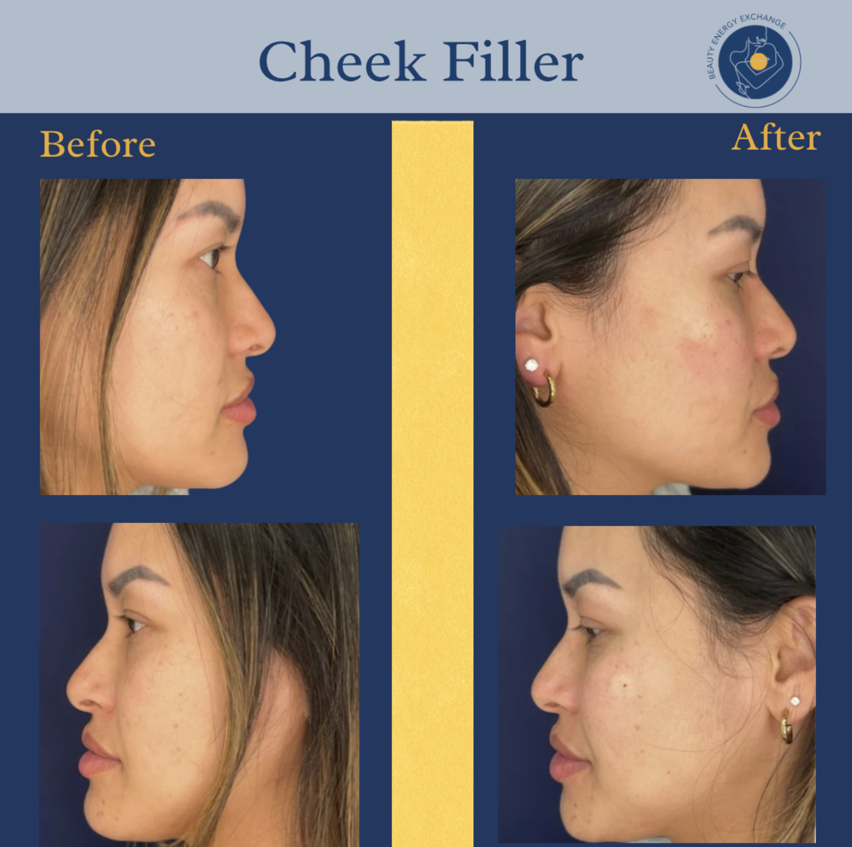 cheek filler San Diego