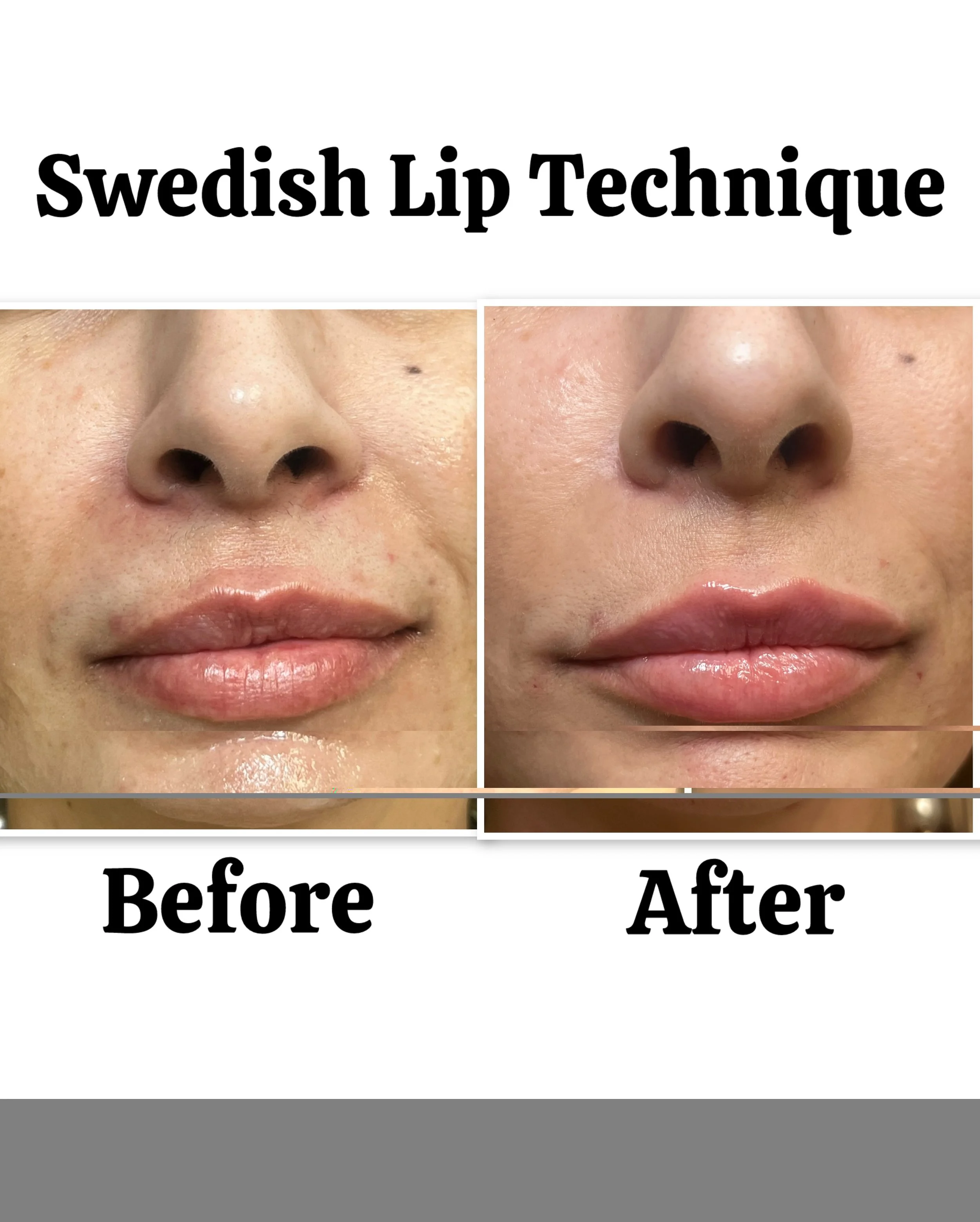 swedish-lip-contouring-san-diego-10.jpeg