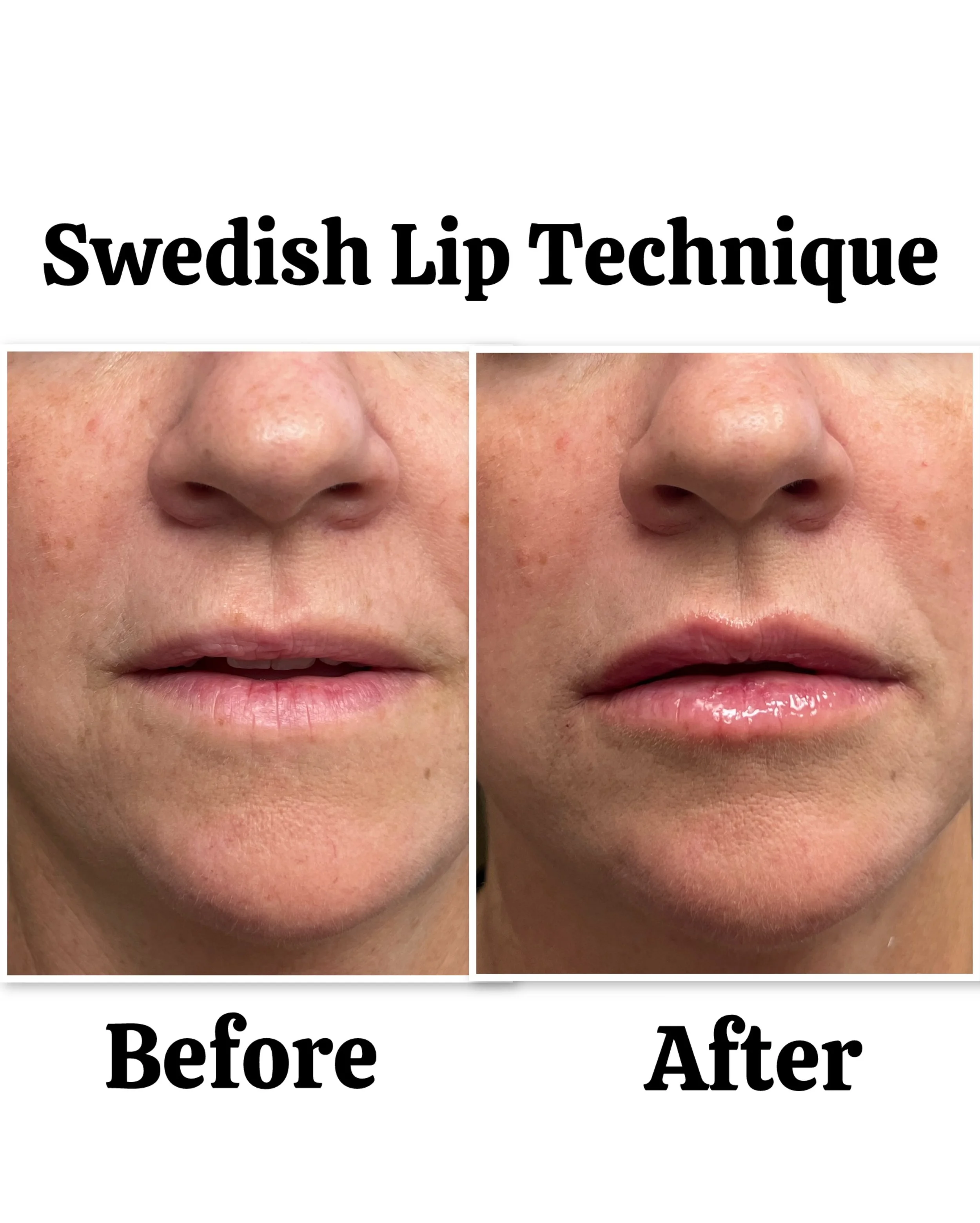professional-lip-enhancement-point-loma-05.jpeg