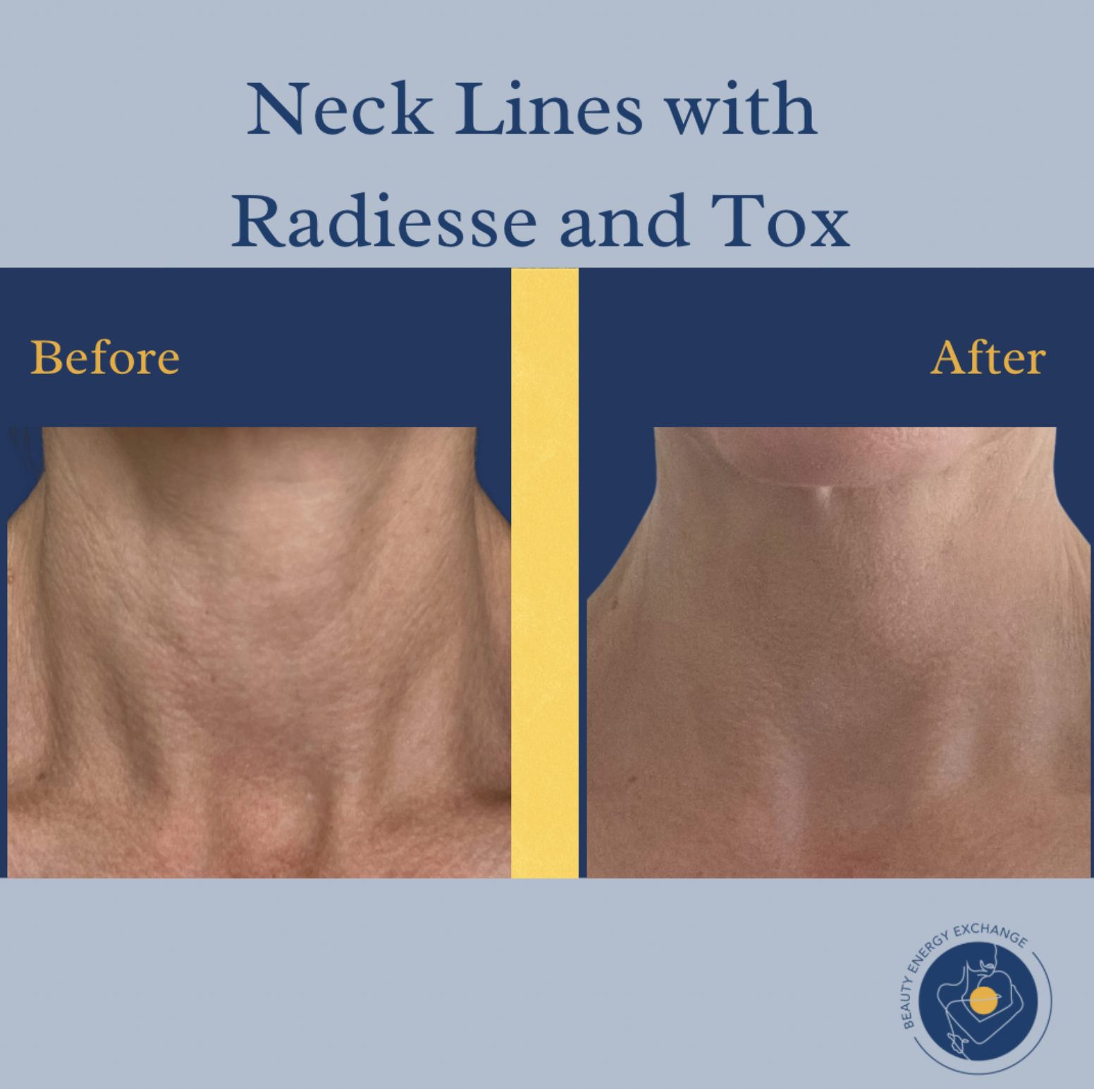 neck lines radiesse before after