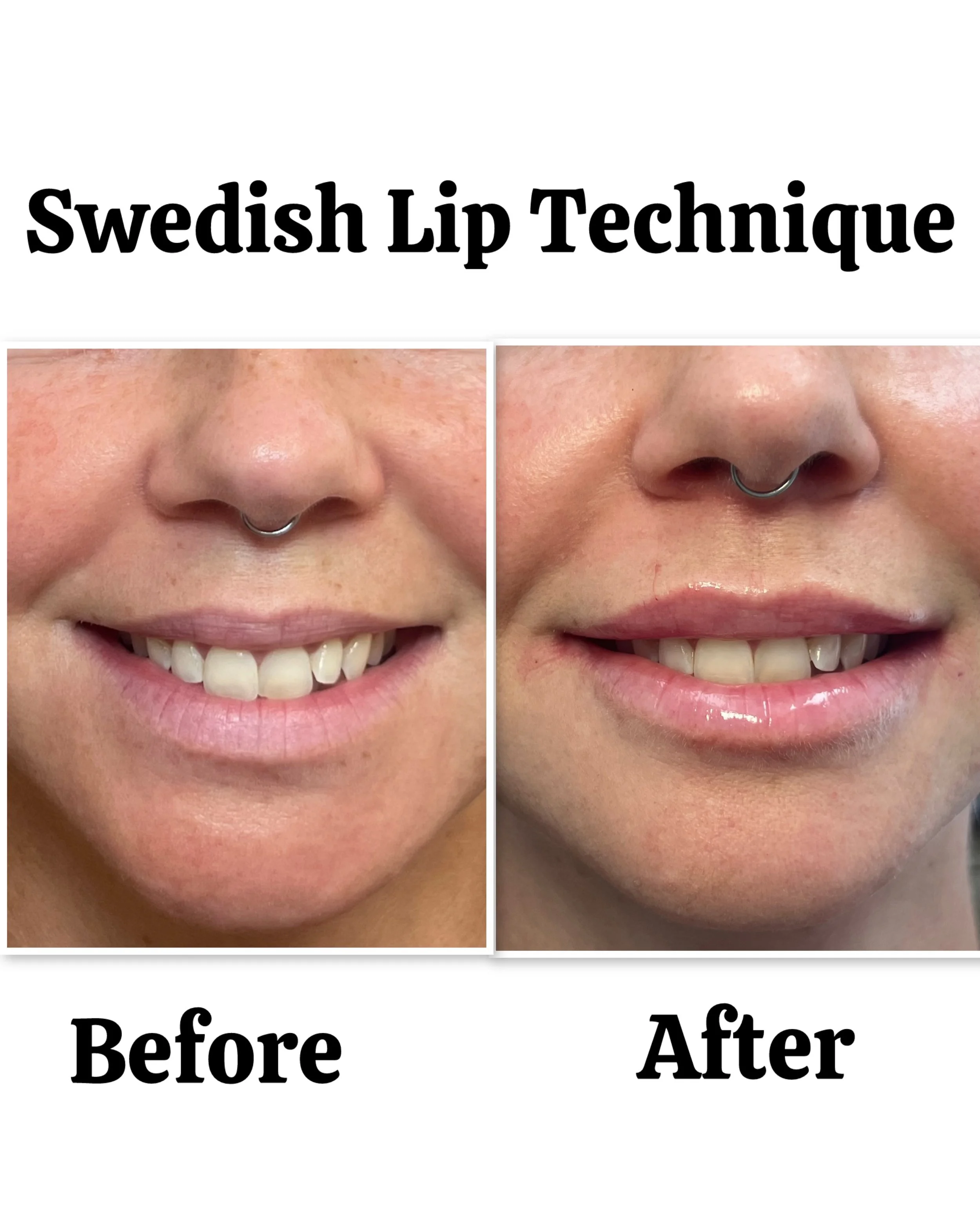 premium-lip-fillers-san-diego-ca-08.jpeg