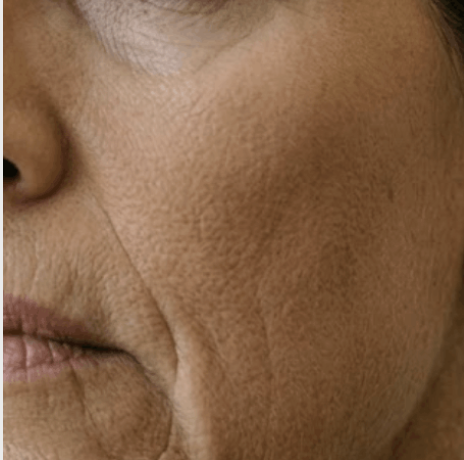skin laxity