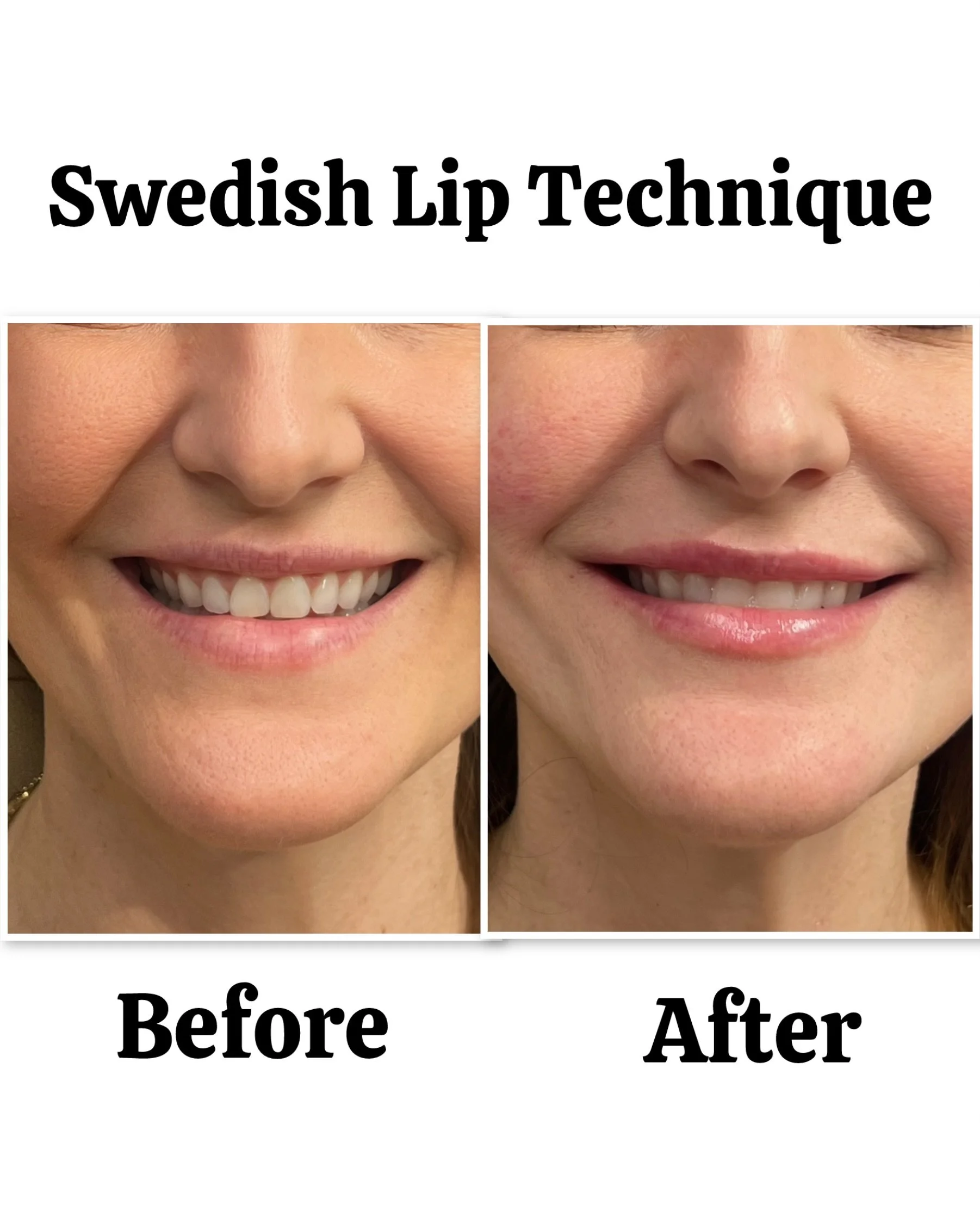 swedish-style-lips-san-diego-med-spa-06.jpeg