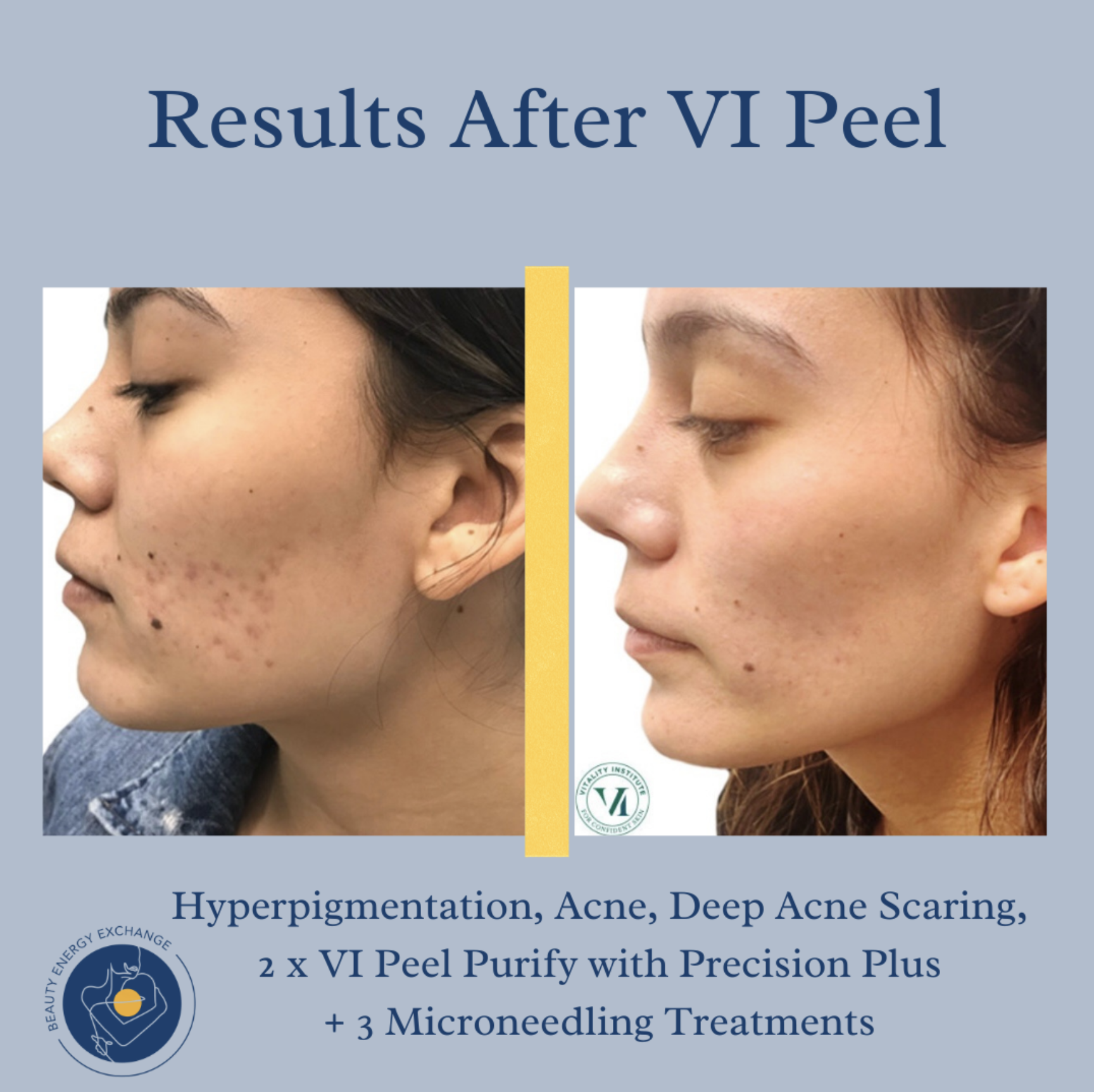 acne chemical peel before after