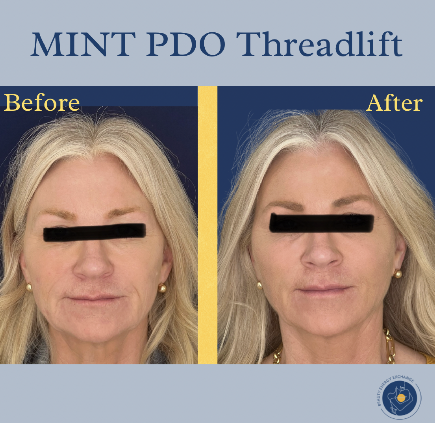 pdo threadlift San Diego