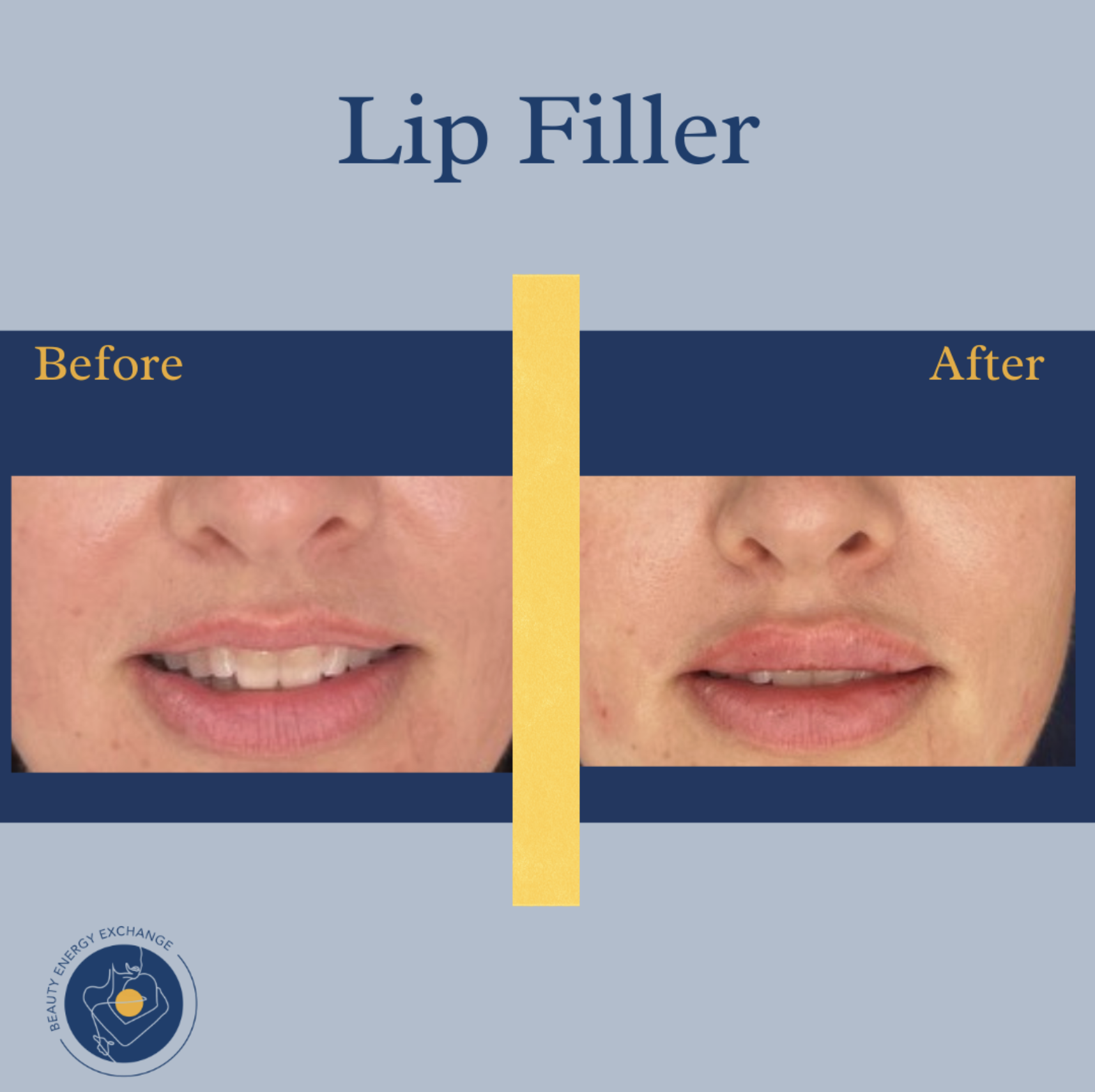 lip filler Ocean Beach