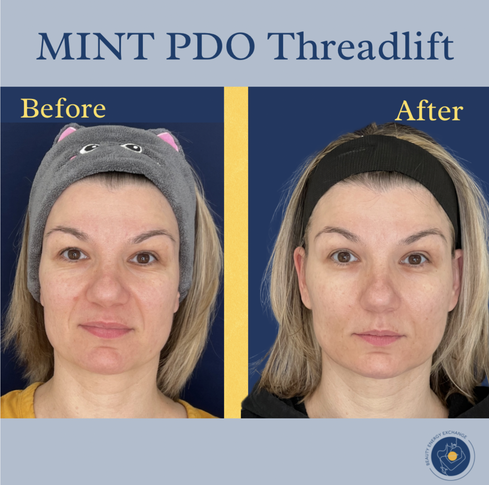 PDO thread lift results
