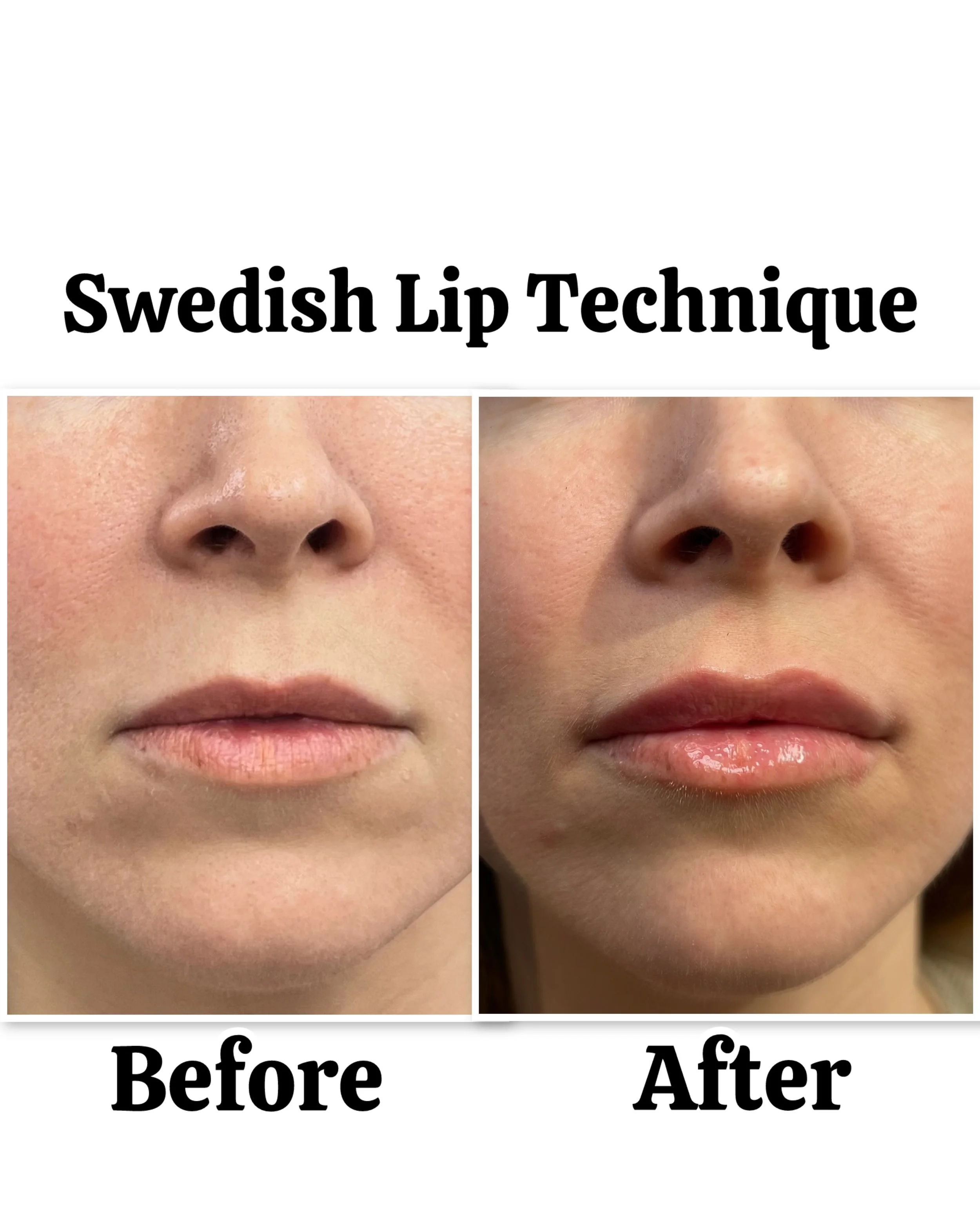 lip-filler-before-after-san-diego-04.jpeg