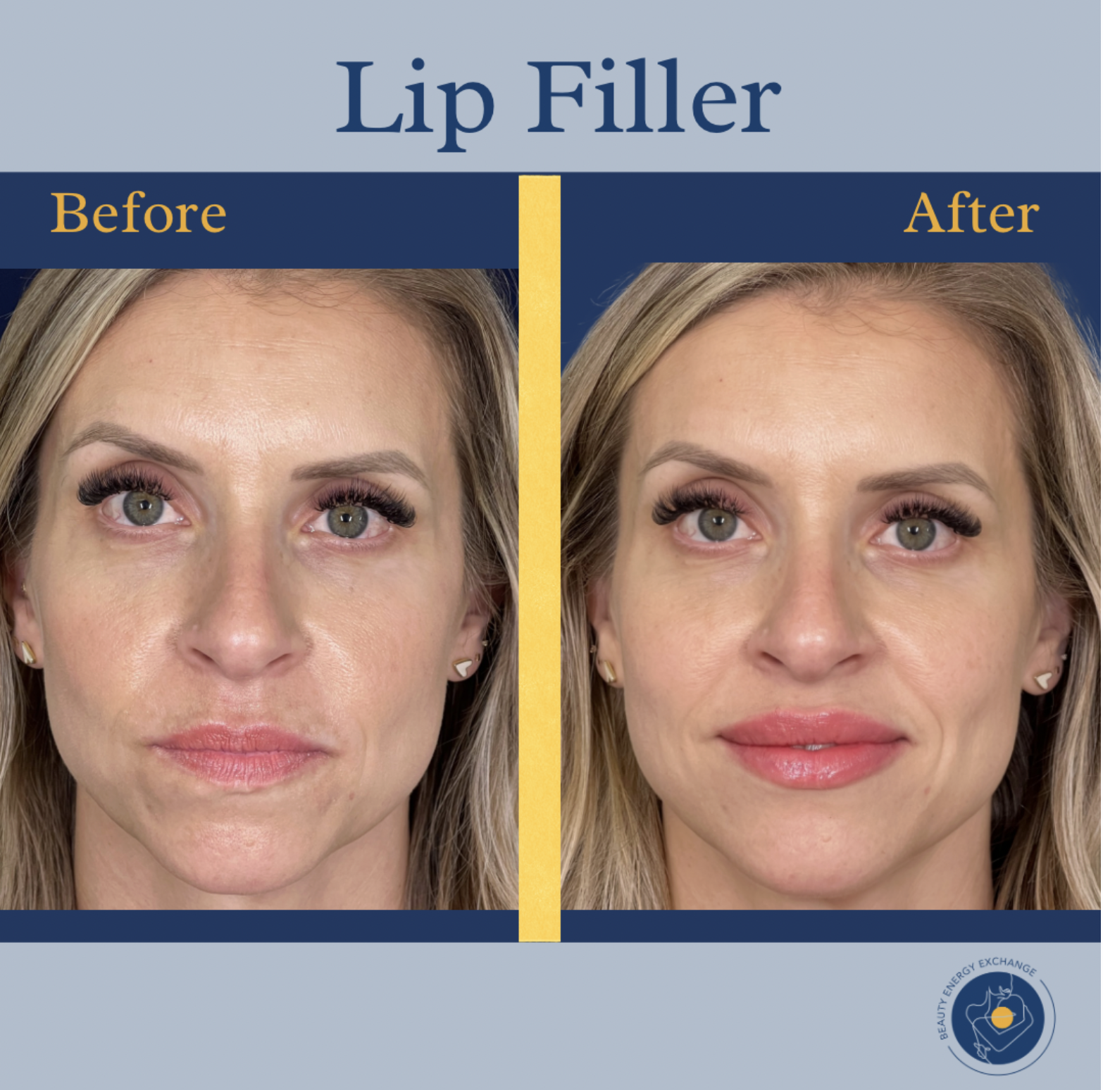 lip filler