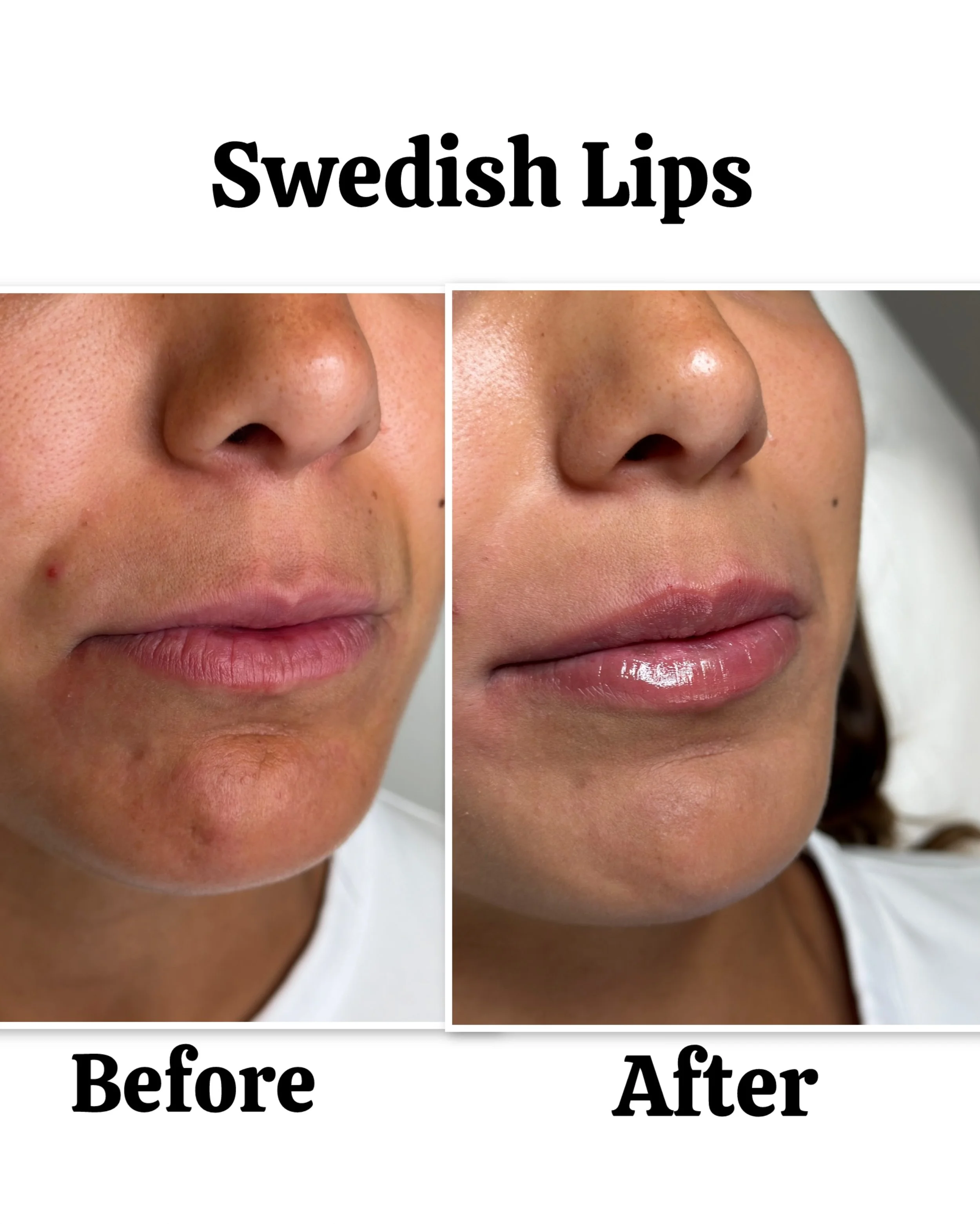 swedish-lip-fillers.jpeg
