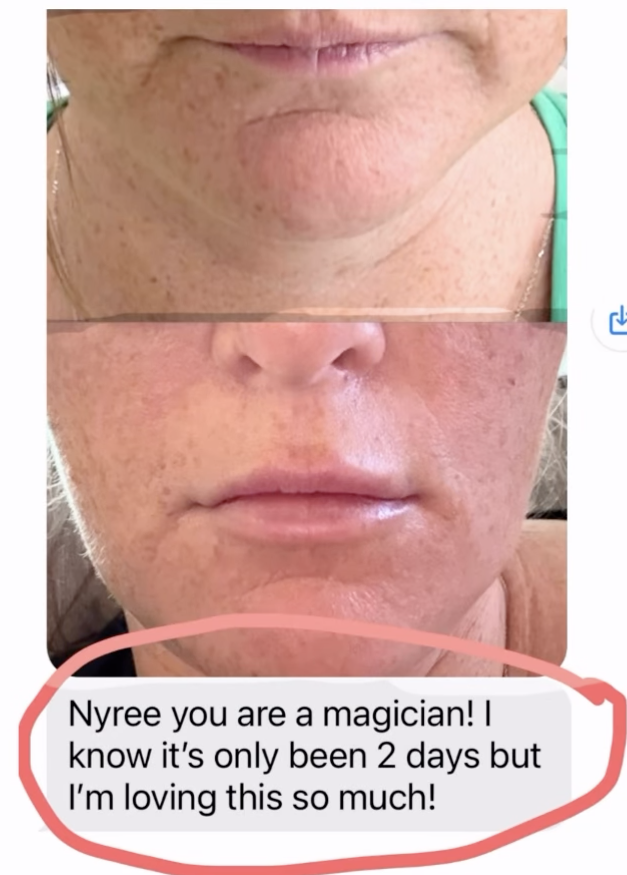 happy lip filler testimonial