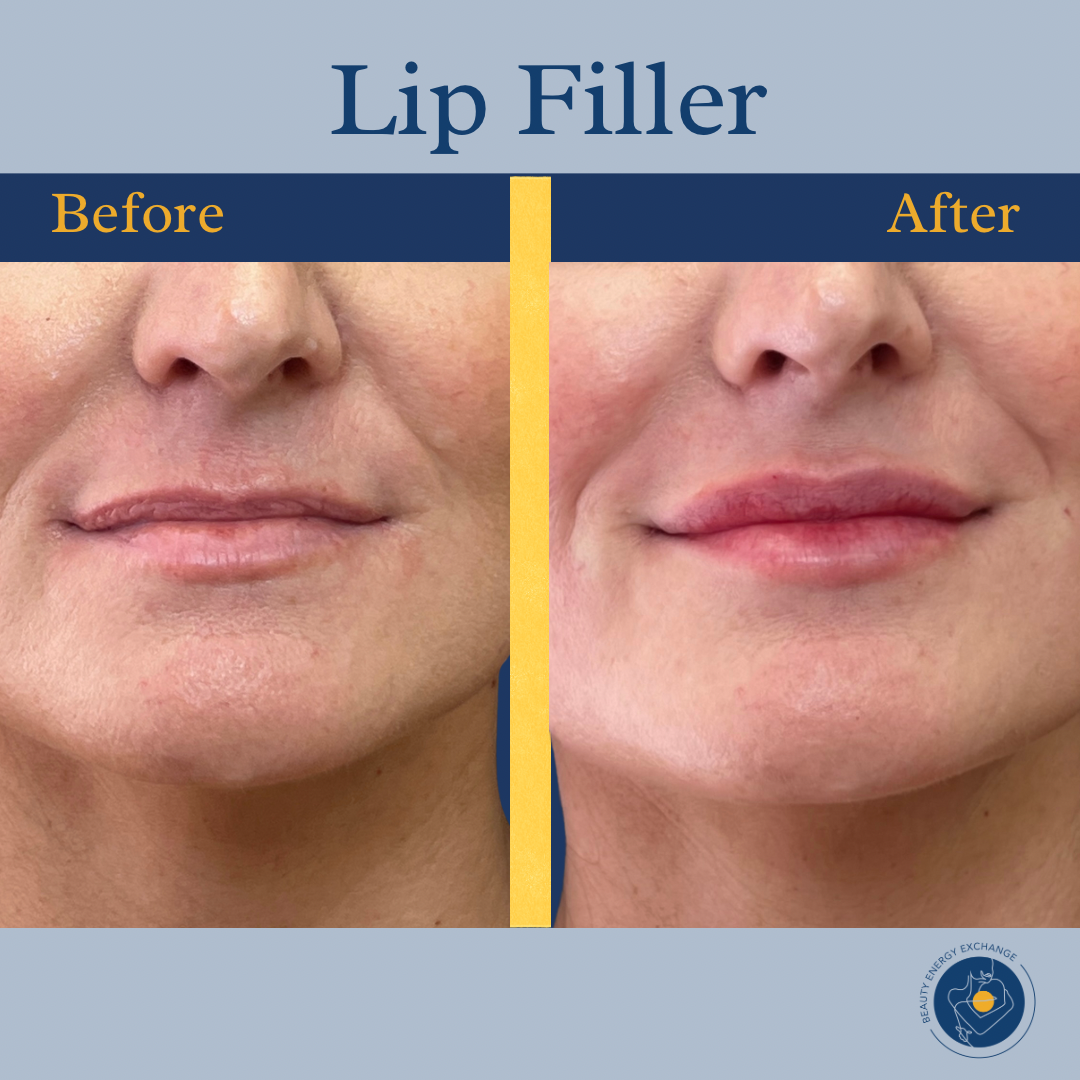 Before and after comparison of lip filler treatment showing fuller lips in the 'after' image.