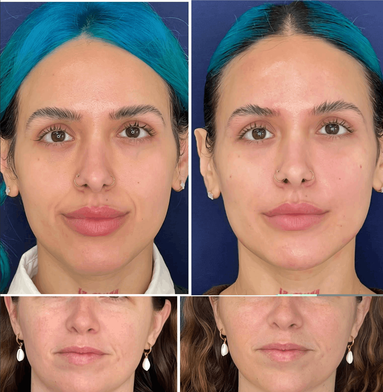 before-after-filler.png