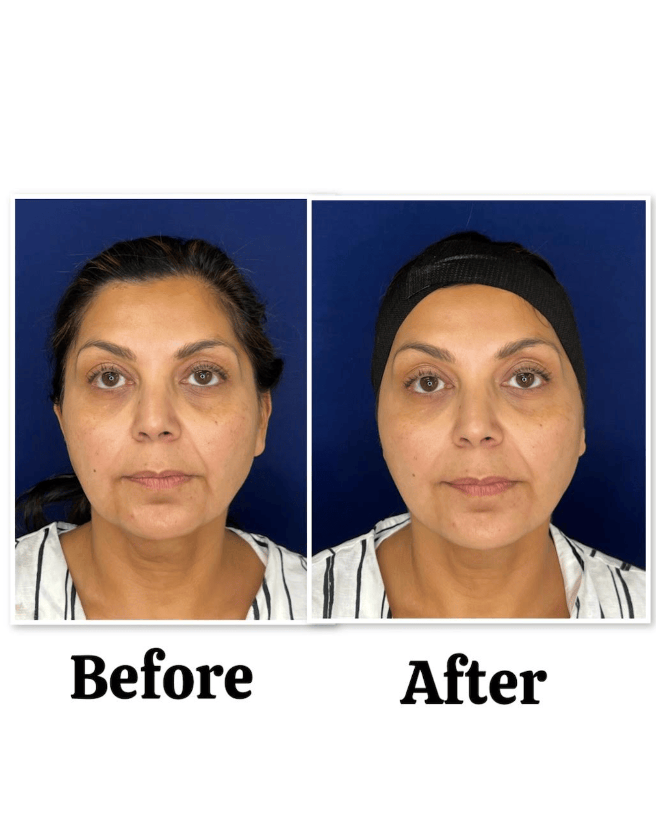 XERF before after photo