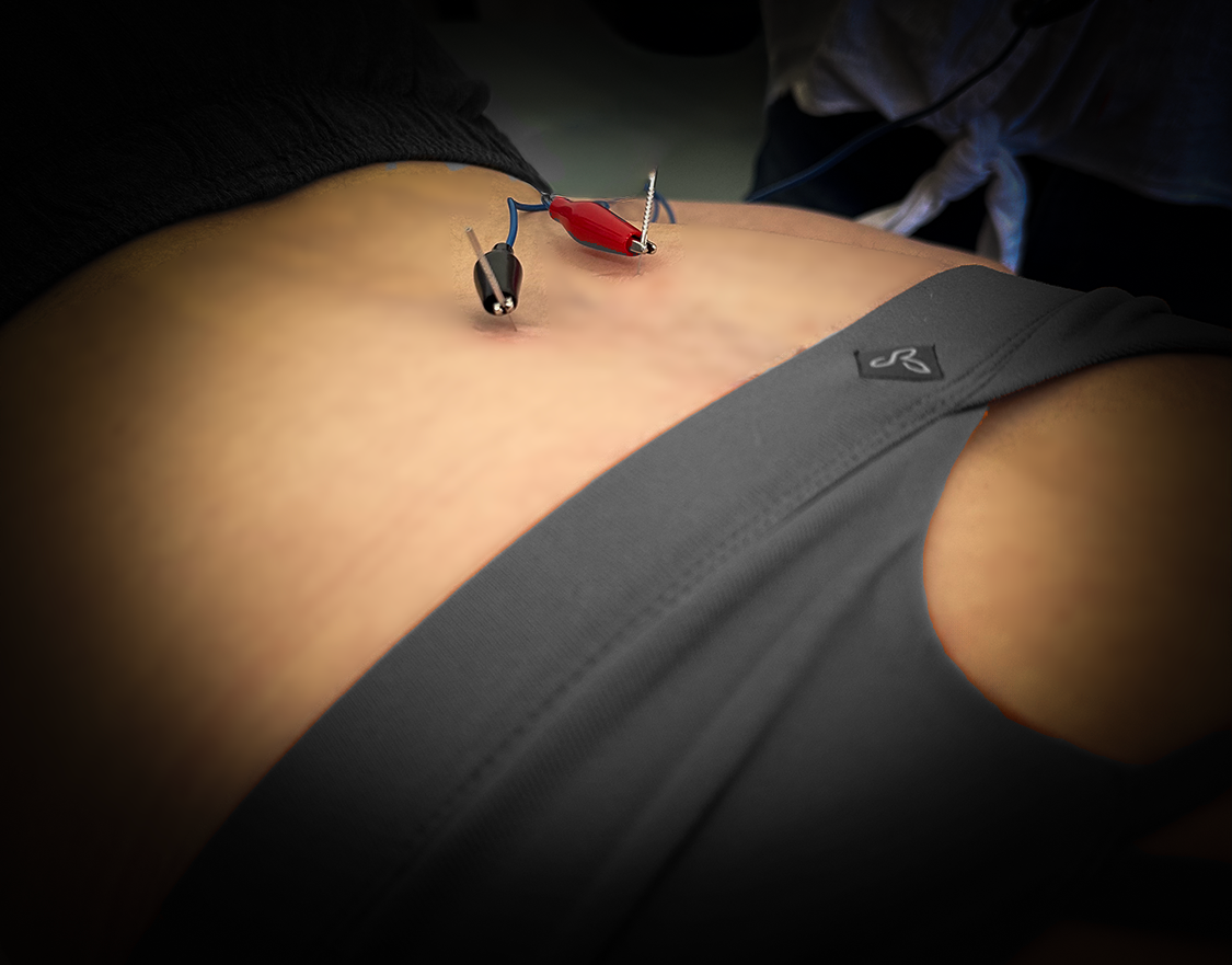 Beyond Foundations in Dry Needling